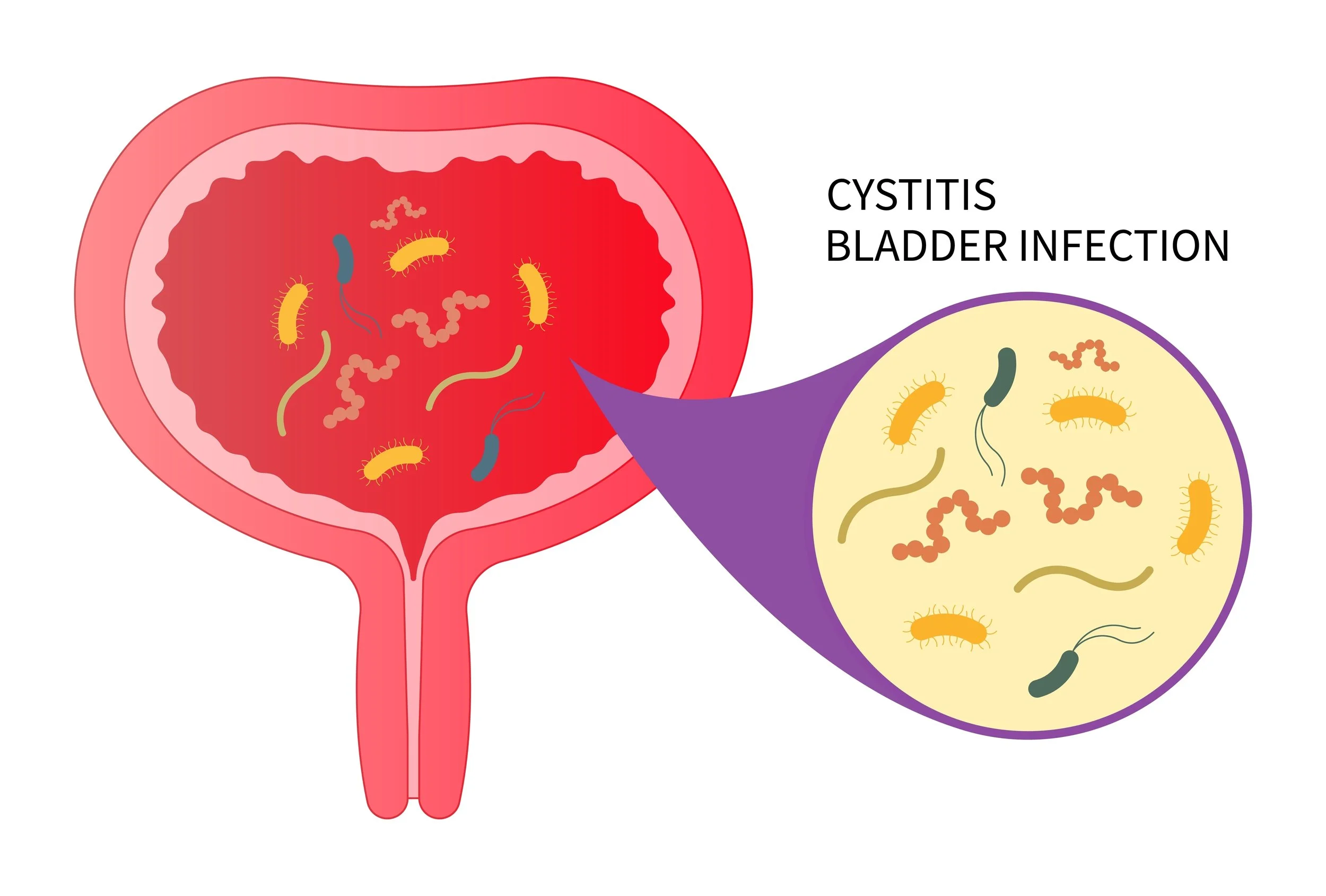 Understanding the Differences and Managing Interstitial Cystitis vs. UTIs