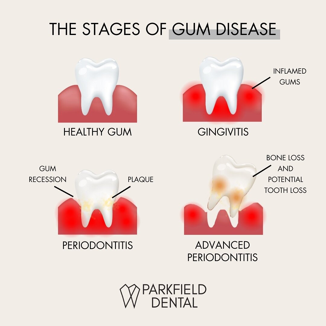 Recognizing gum disease, or periodontal disease, is crucial as it can progress through various stages. Be vigilant for these common signs, and remember that regular dental check-ups, along with good oral hygiene practices, play a key role in maintain
