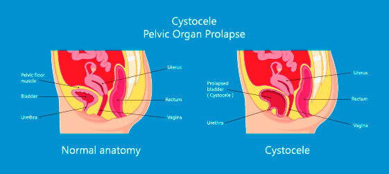 What is prolapse? — SheSpot