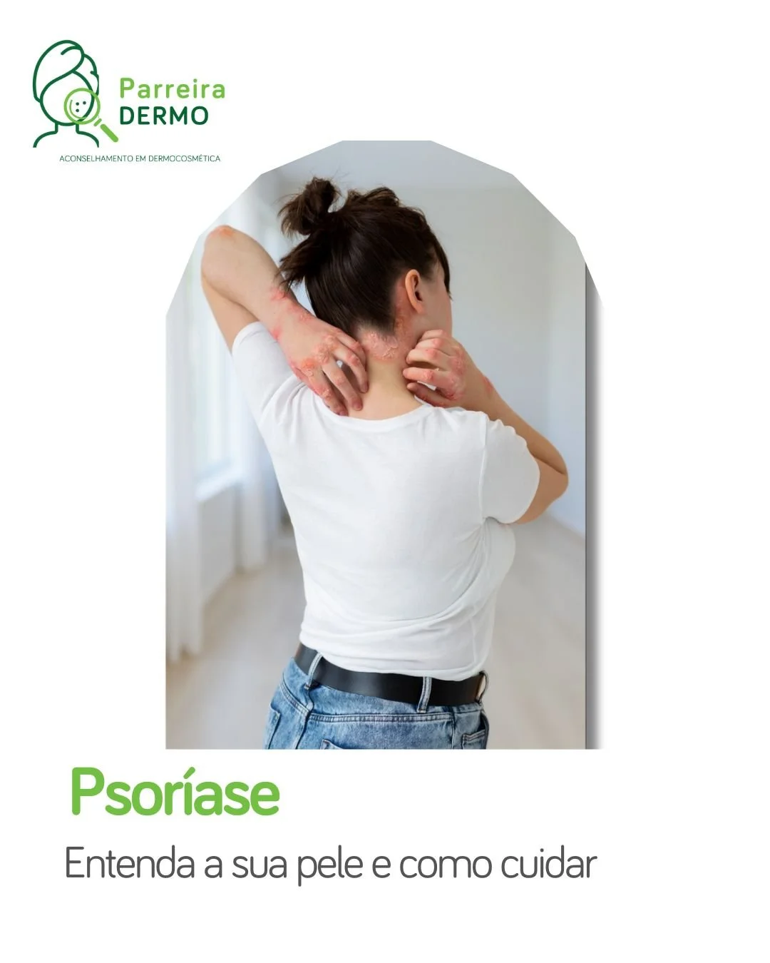 Psor&iacute;ase: como cuidar da pele de forma adequada?

A psor&iacute;ase &eacute; uma doen&ccedil;a cr&oacute;nica, n&atilde;o contagiosa, que provoca placas vermelhas, descama&ccedil;&atilde;o e comich&atilde;o.
Os fatores que podem desencadear cr