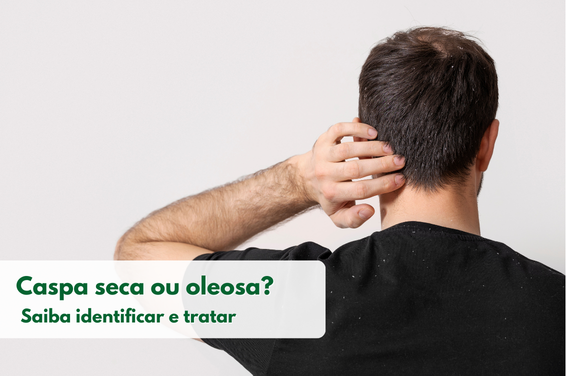 Caspa seca ou oleosa? Saiba identificar e tratar