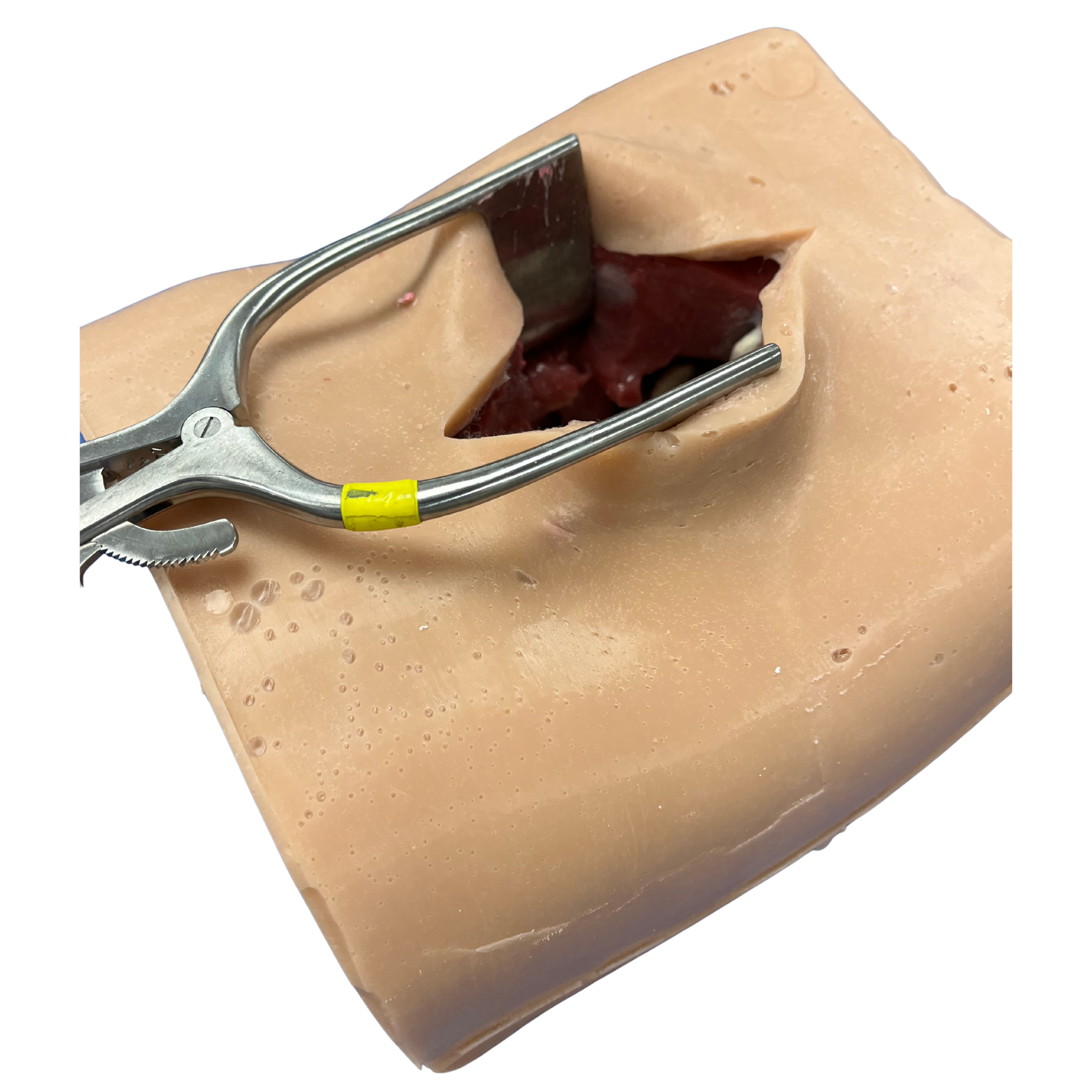 Thoracolumbar Spine - Neuromodulation (L1 - T6)