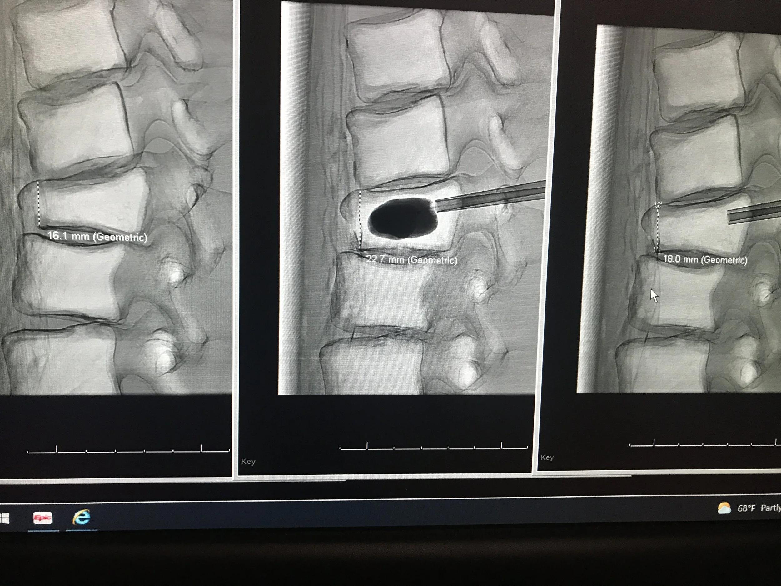 Pre and post vertebral compression imaging for Viomerse's vertebral compression fracture phantom training model.