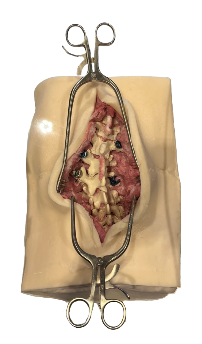 Thoracolumbar Deformity Spine