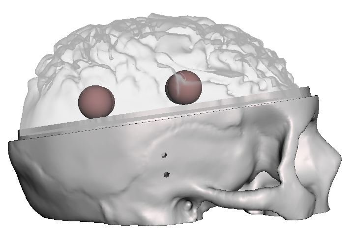 Subcortical Brain Tumors side.JPG (Copy)