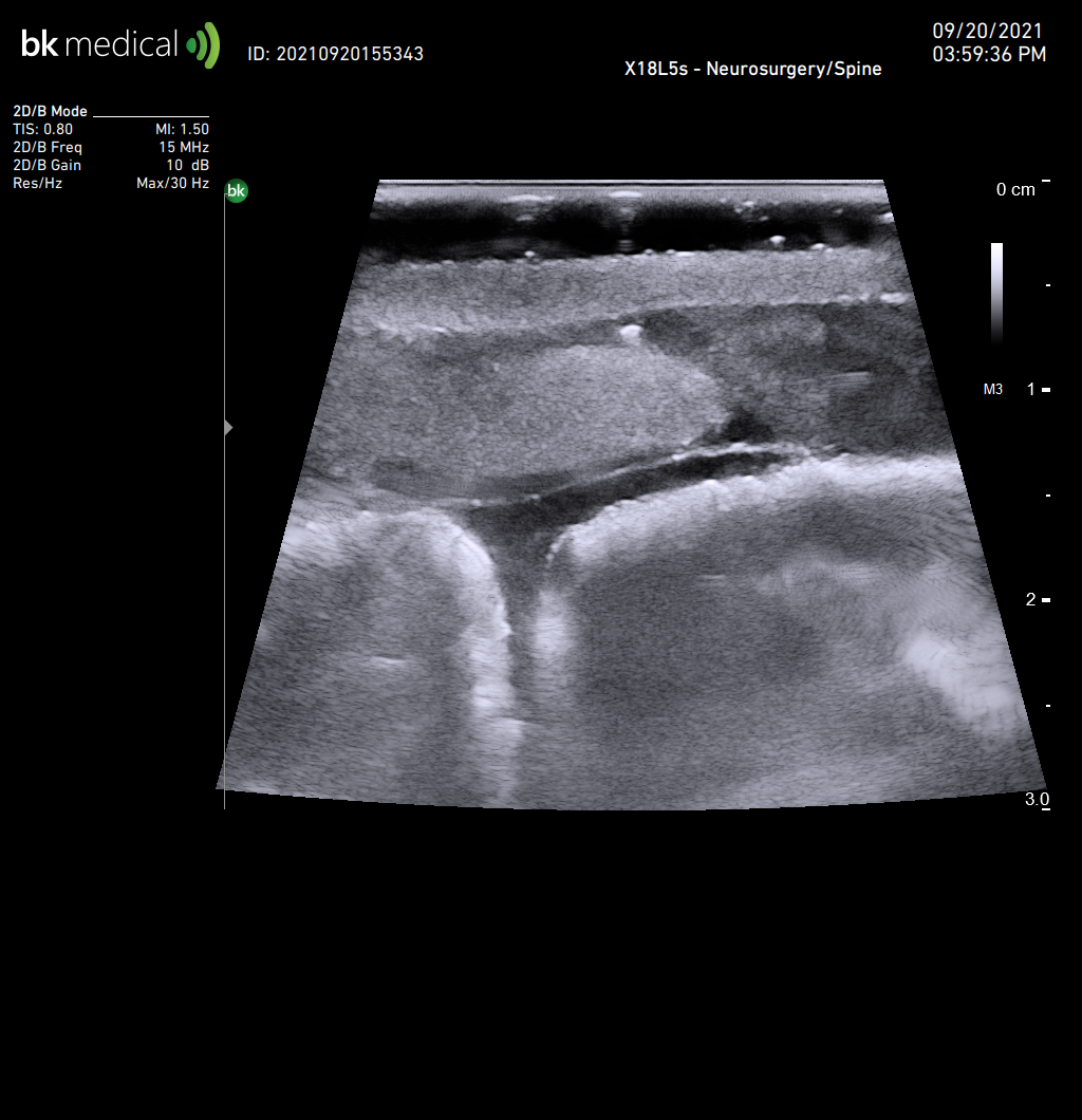 Ultrasound image of Viomerse's spine discectomy phantom training model.