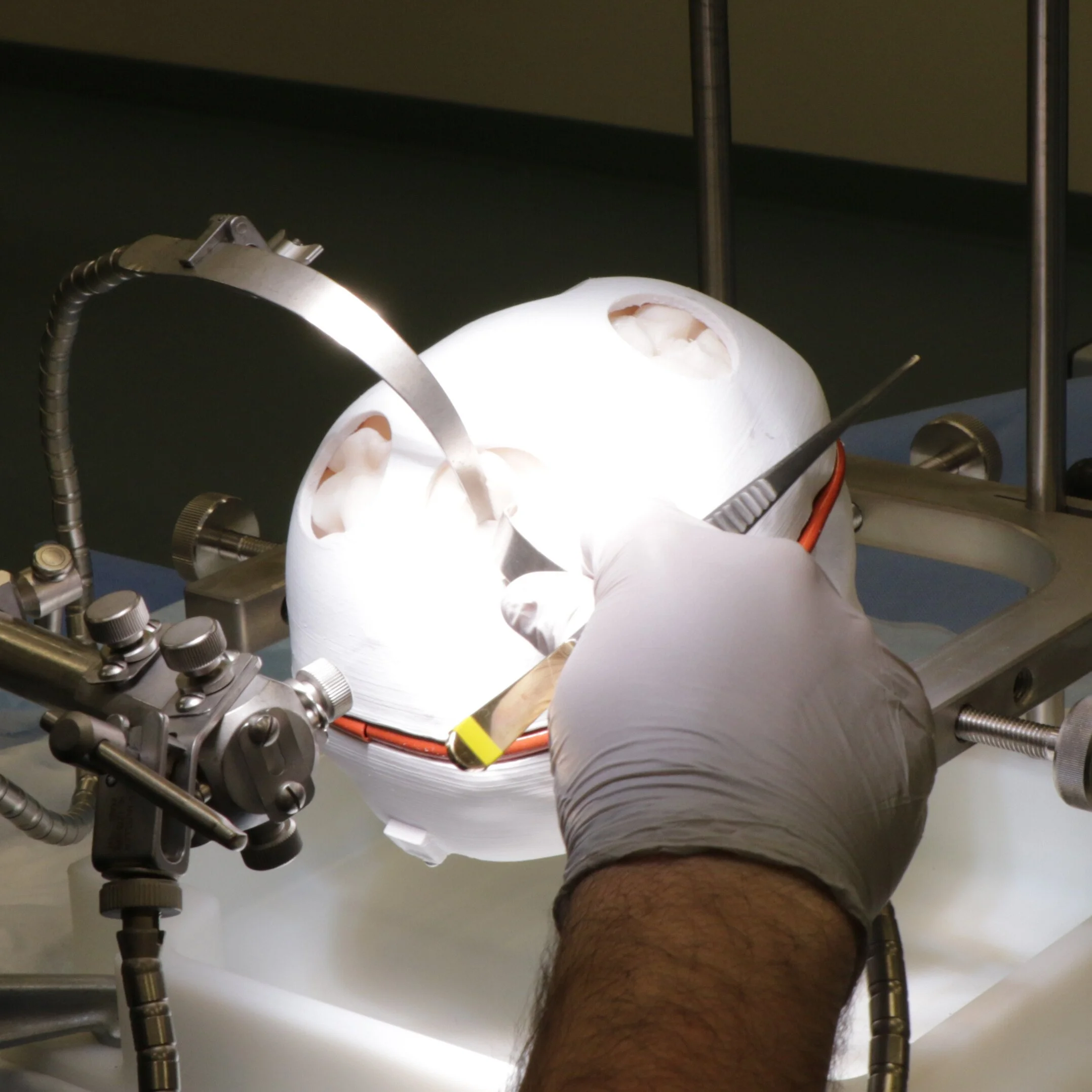 Fluoroscopy compatible synthetic brain surgery training model with 4 resectable subcortical brain tumors, encased in plastic skull.