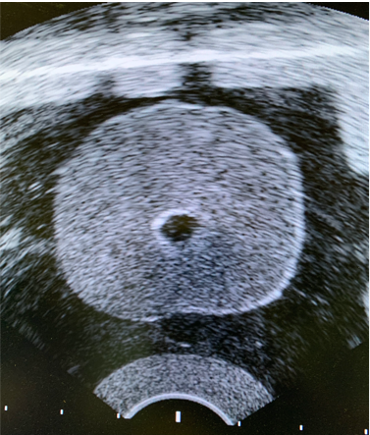 Ultrasound image of Viomerse's prostate phantom training model without lesions.