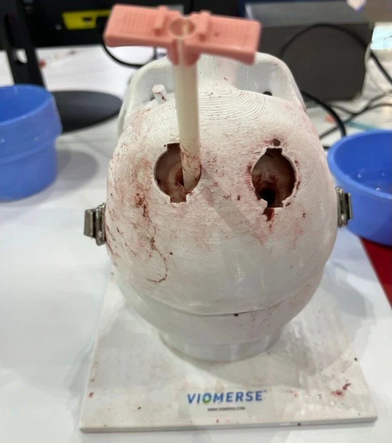 Realistic hydrogel brain training model containing 2 hematomas, mimicking intracerebral hemorrhage.