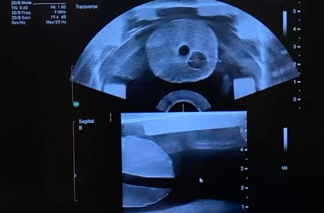Ultrasound image of Viomerse's prostate phantom with tumor and lesions.