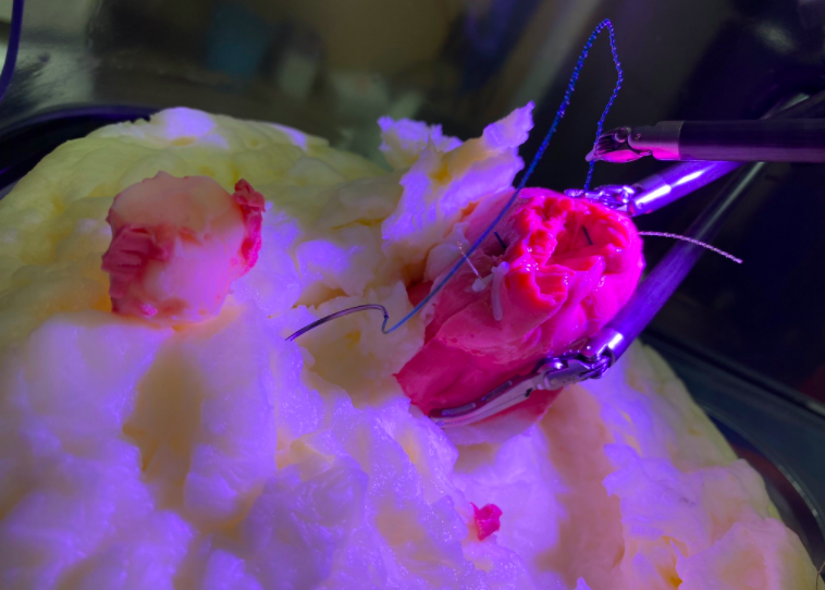 Viomerse's Partial Nephrectomy Phantom Disected