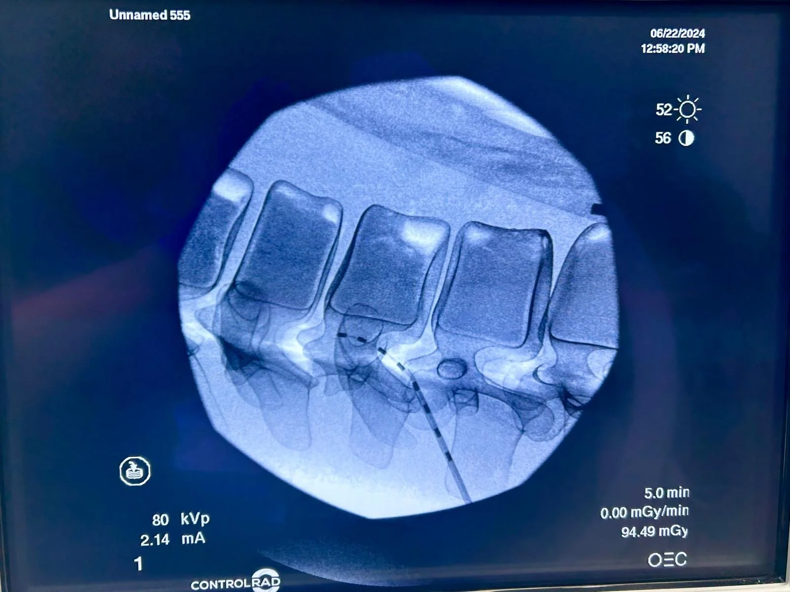 X-Ray scan of Viomerse's Synthetic Thoracolumbar Spine Training model containing L1-T6 intended for Neuromodulation