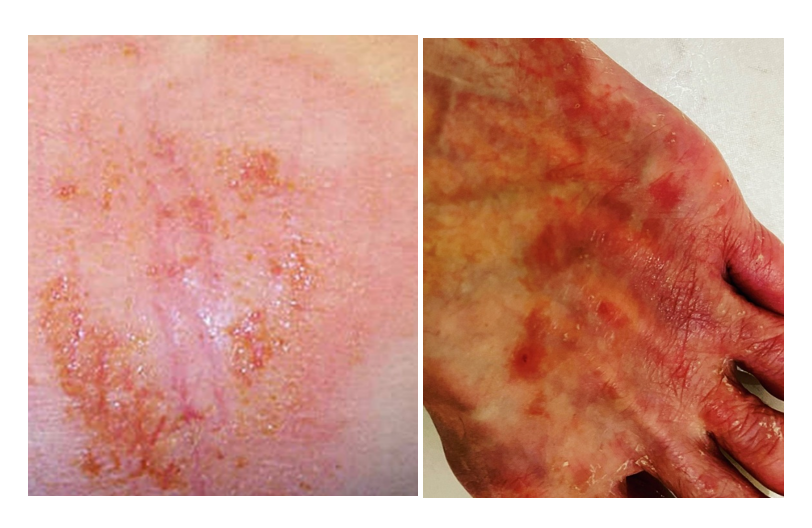 National Eczema Week is in September ! — Eat Drink Think Nutrition®