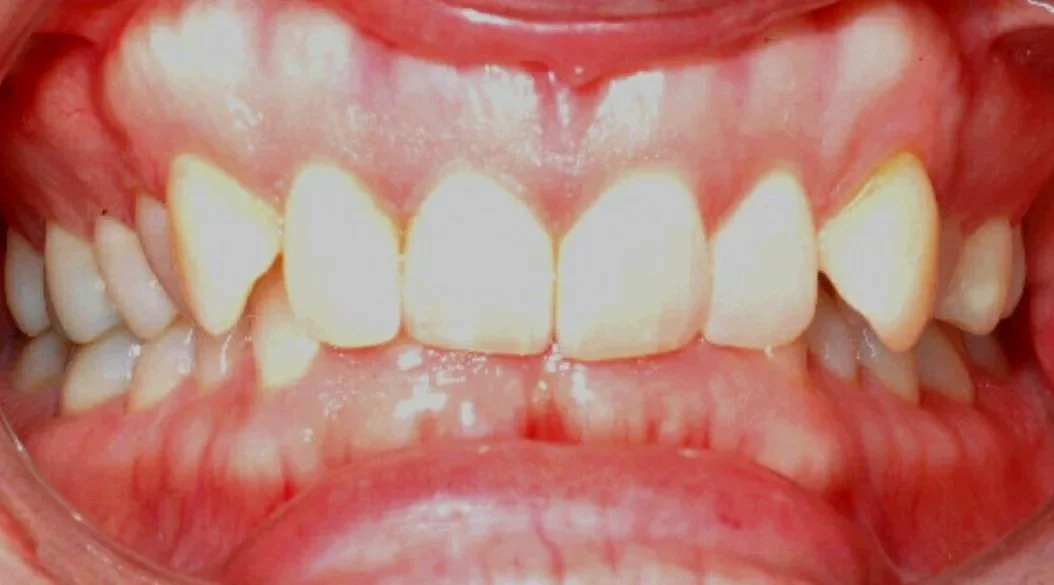 Overbite