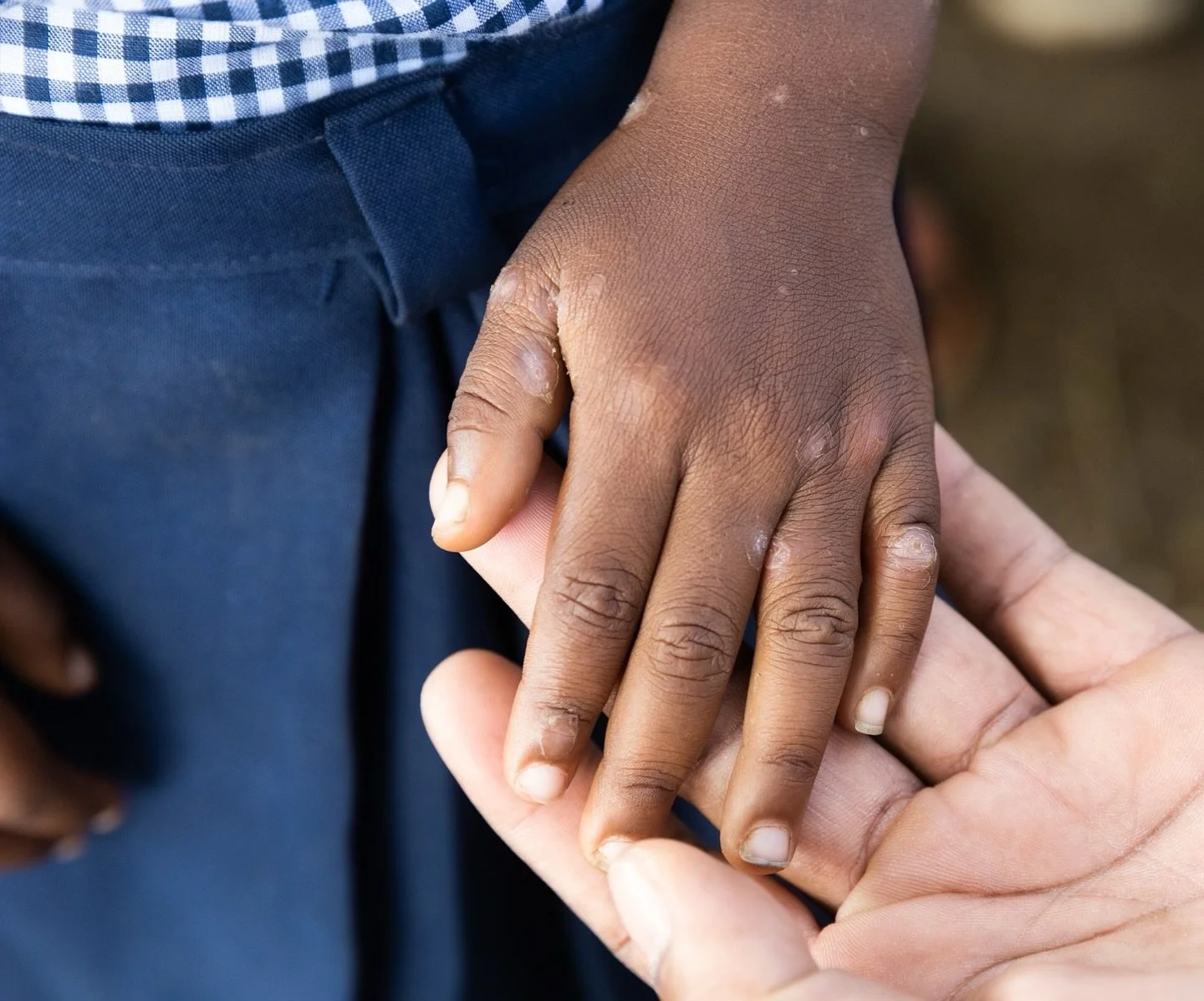 In Haiti, unsafe water can lead to painful skin infections like impetigo, scabies, and fungal rashes&mdash;especially in children. 💔

At Project Medishare, we work to prevent this by producing chlorine to disinfect water used for drinking, washing a