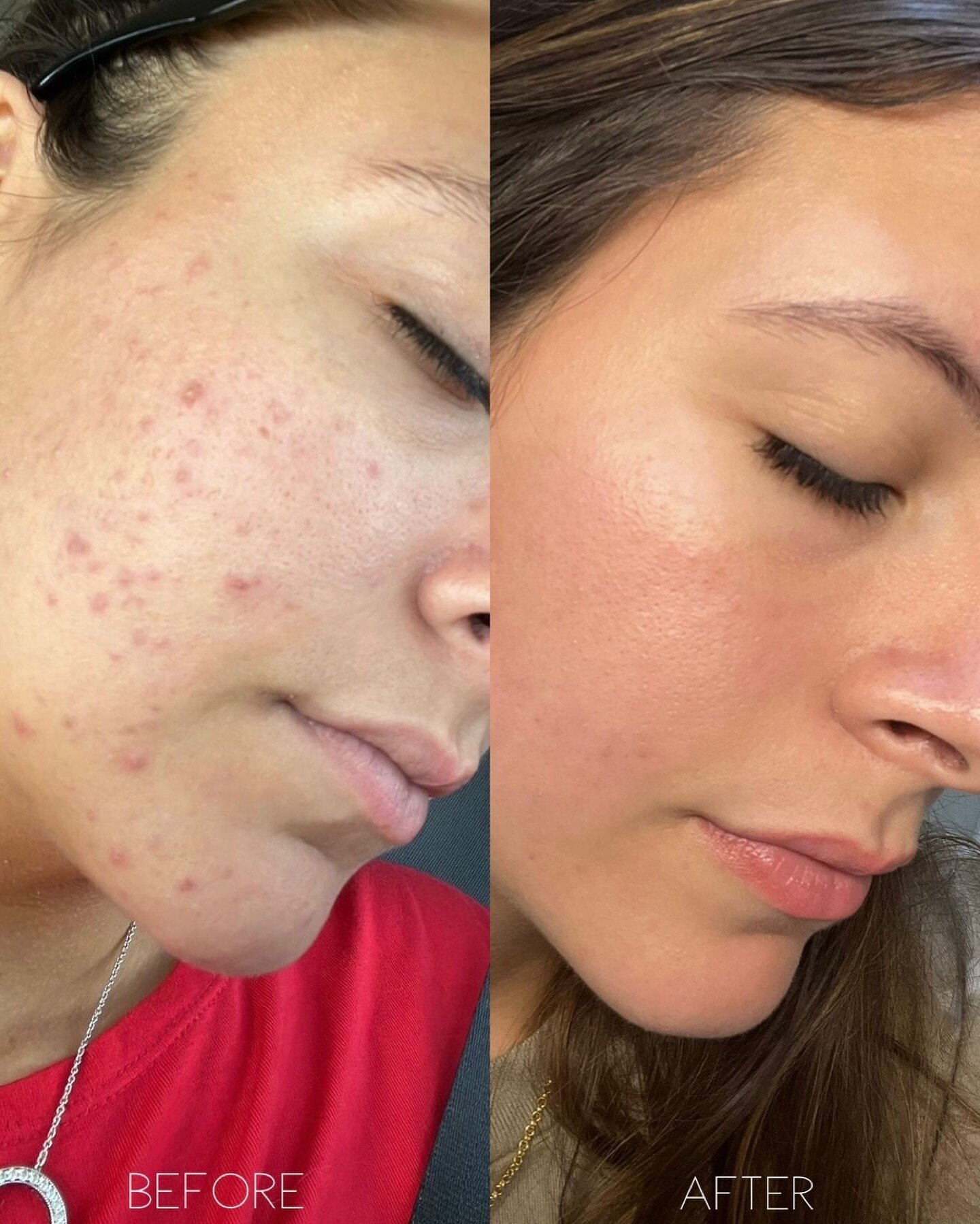 Results like this make my job so worth it❣️

Don&rsquo;t wait to take care of your acne, start your journey today 
#beforeandafter #beforeandafteracne #skincare #skin #facials #facialsnearme #fortlauderdalefacials #lighthousepointfacials #facialnearm