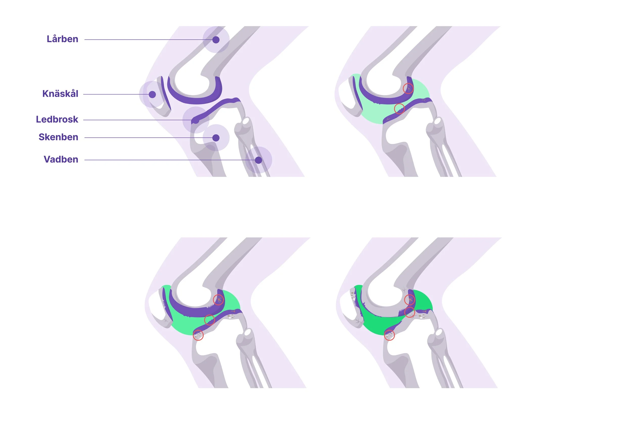 Svullet knä med artros? Specialistläkaren om knäsvullnad vid artros ...