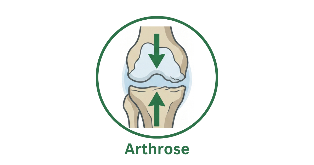 Arthrose