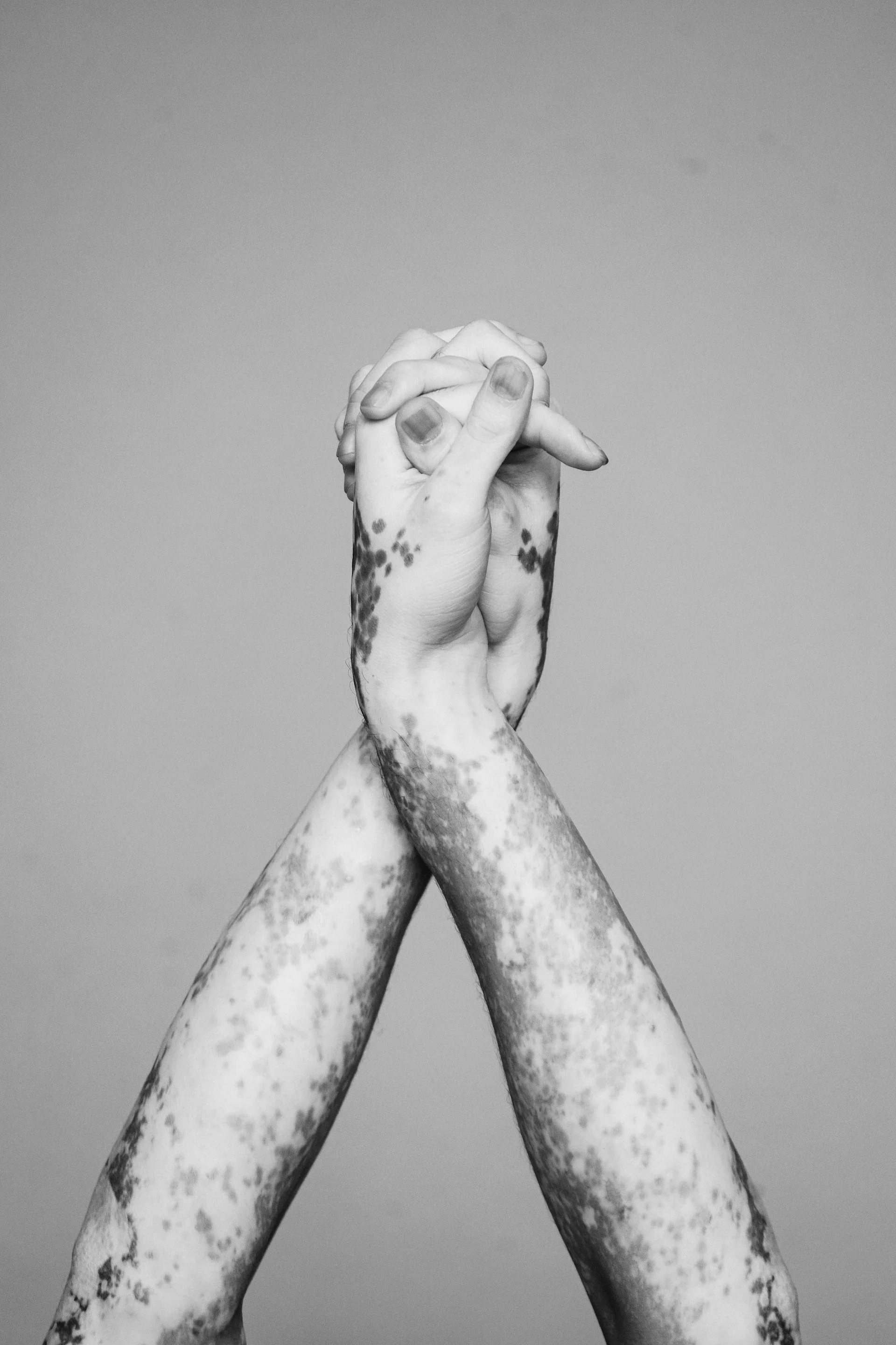 Black and white photo of two hands intertwined and raised against a plain background, with visible freckles or birthmarks on the arms.