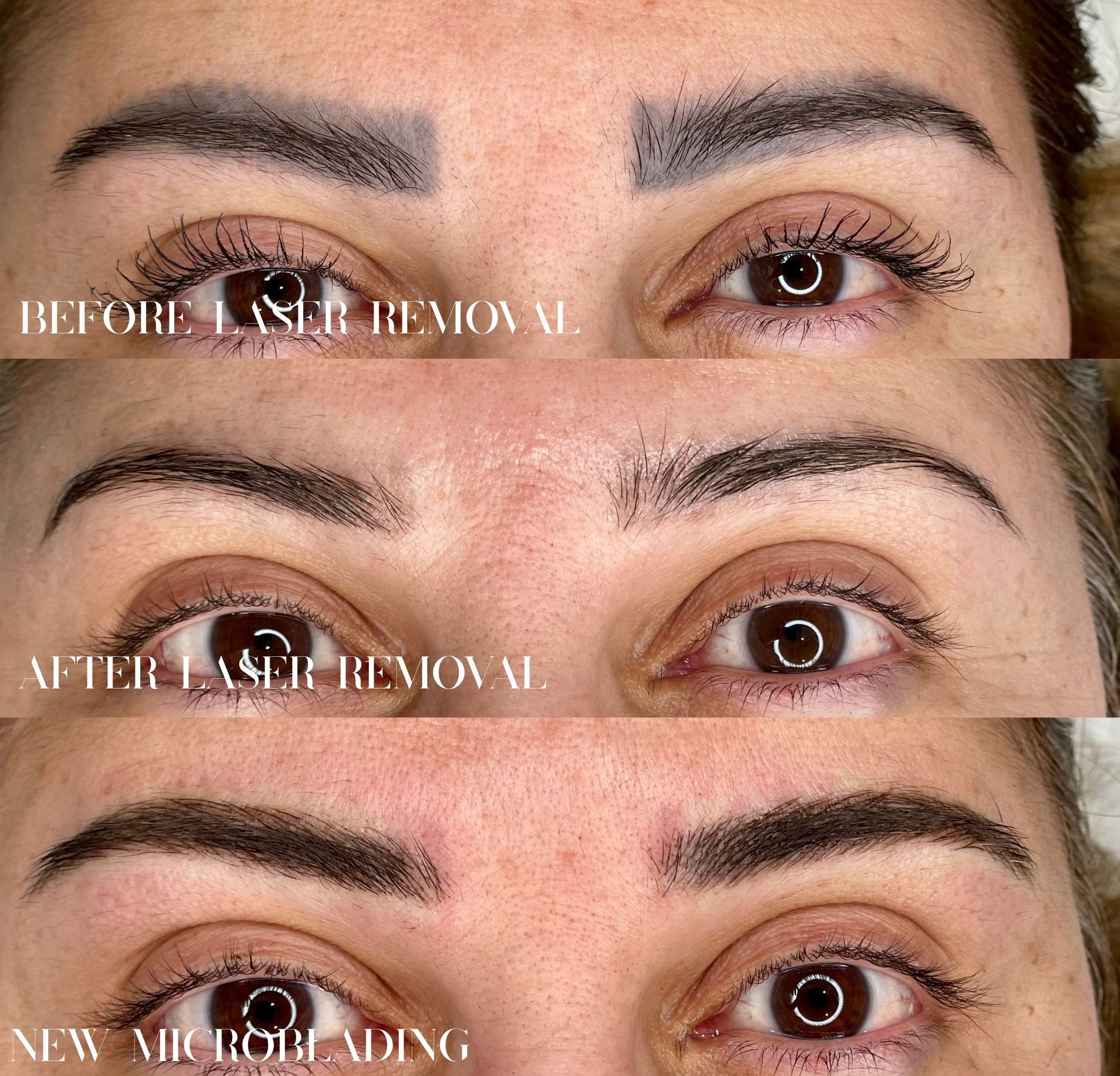 Laser removal of a dark, blocky eyebrow tattoo in Surbiton, Surrey: before laser, faded after laser sessions, then soft new microbladed brows