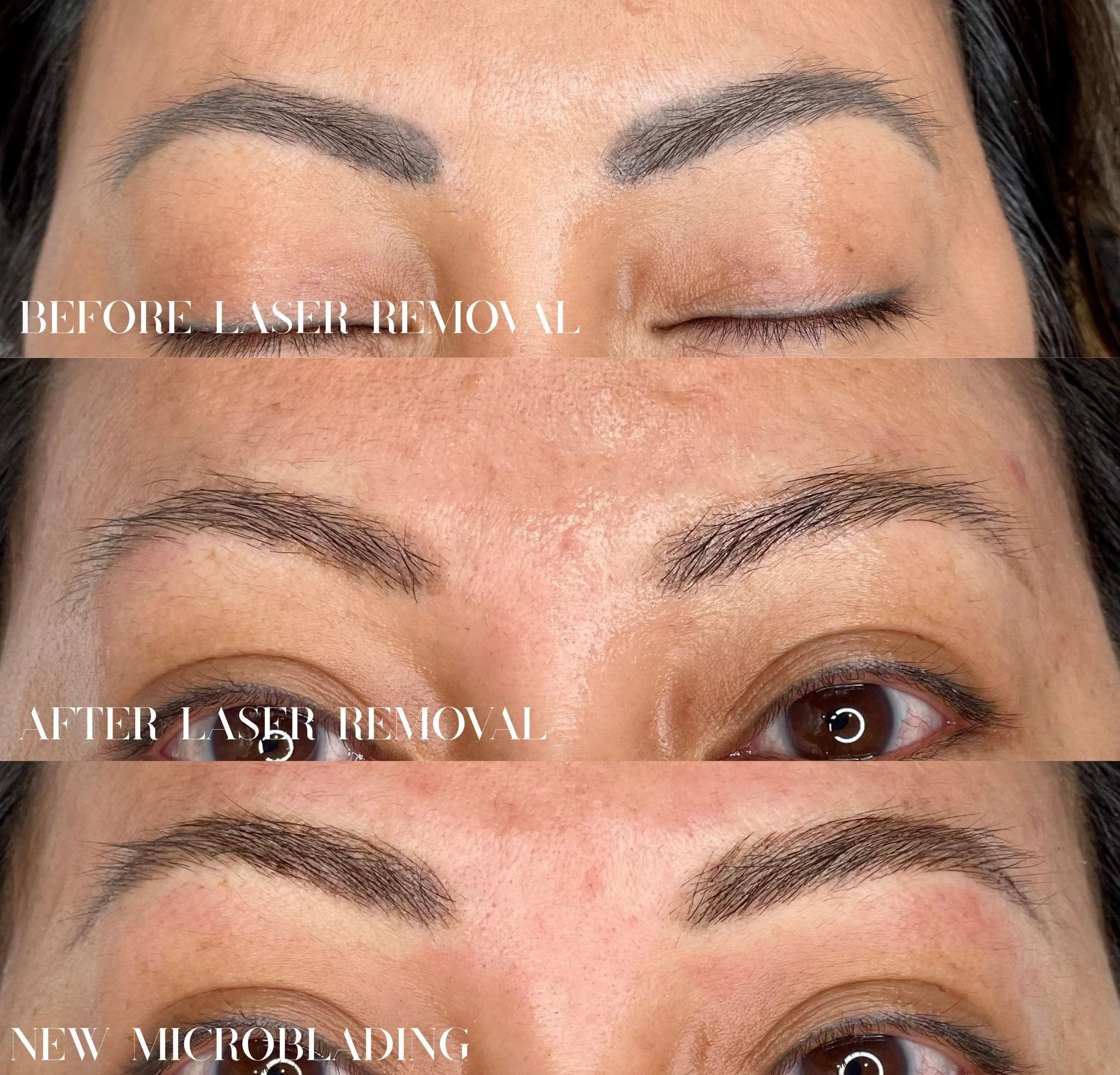 Laser eyebrow tattoo removal in Surbiton, Surrey: old dark brow tattoo before laser, faded after laser sessions, then new microblading