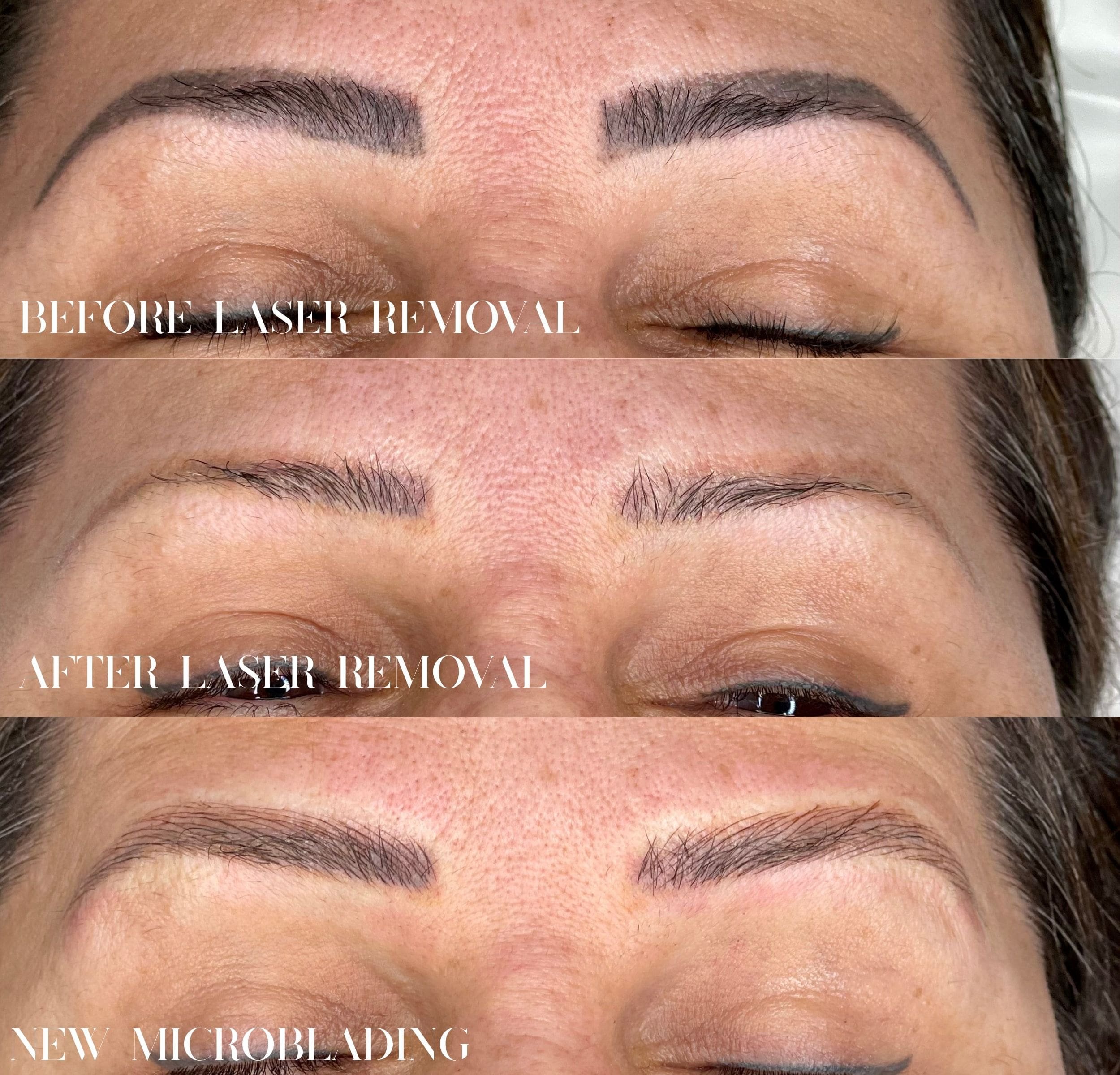 Before and after laser brow tattoo removal: old tattooed brows lightened by laser, followed by a microblading redo in Surbiton