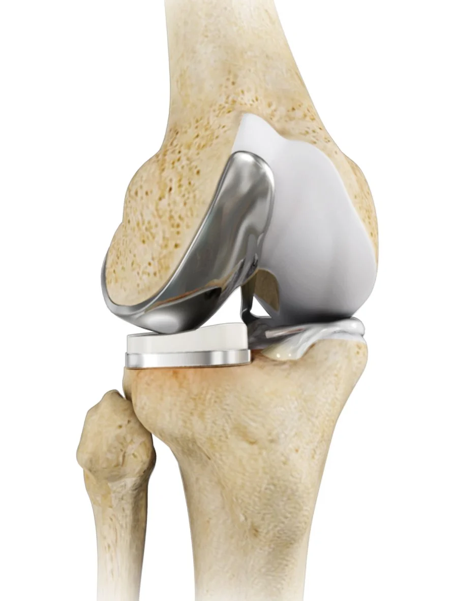 Unicompartmental knee replacement, partial knee replacement, best knee surgery Auckland