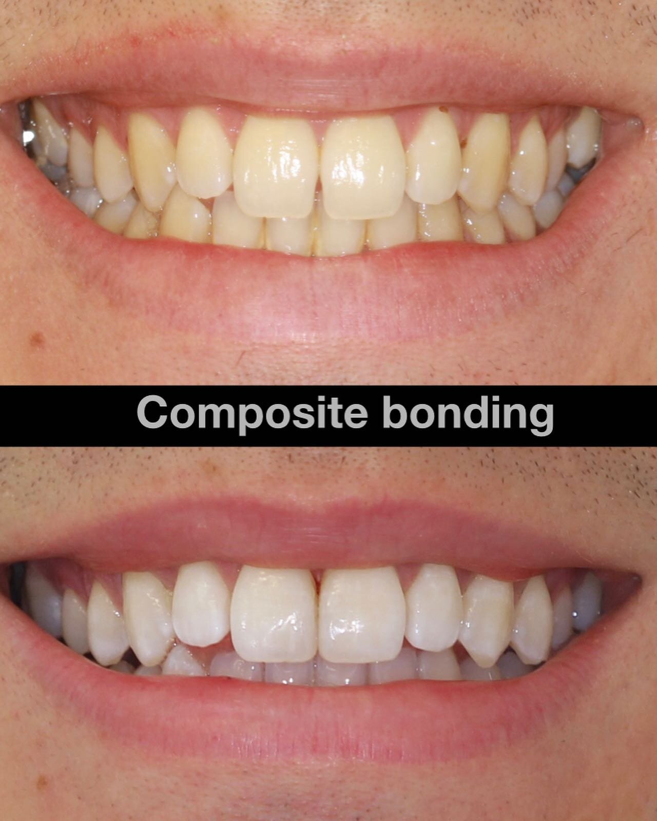 Sometimes it&rsquo;s the small change that can make a big impact. After the whitening, the patient needed one more quick appointment to do the composite bonding, and left happy, ready to show off his smile! 
.
.
.
#compositebonding #closethegap #cosm