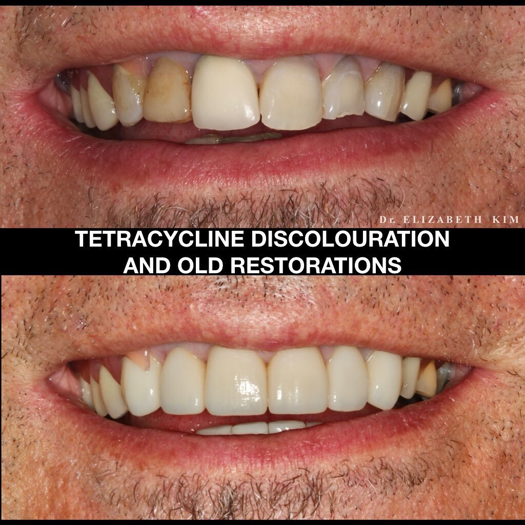 From stained and broken teeth to symmetrical and bright smile! ✨ A combination of porcelain veneers and crowns can mask the discolouration from the antibiotic, strengthen broken teeth and restore the smile. 
.
.
.

#porcelainveneers #smilemakeover #n