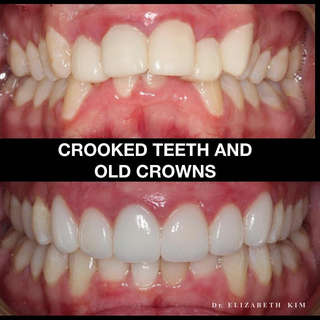 It was a long journey from crooked teeth, poorly made crowns and veneers to a beautiful straight white smile with the Invisalign treatment, then replacing the crowns and veneers. 
.
.

#porcelainveneers #smilemakeover #nzdentist #cosmeticdentist #cos