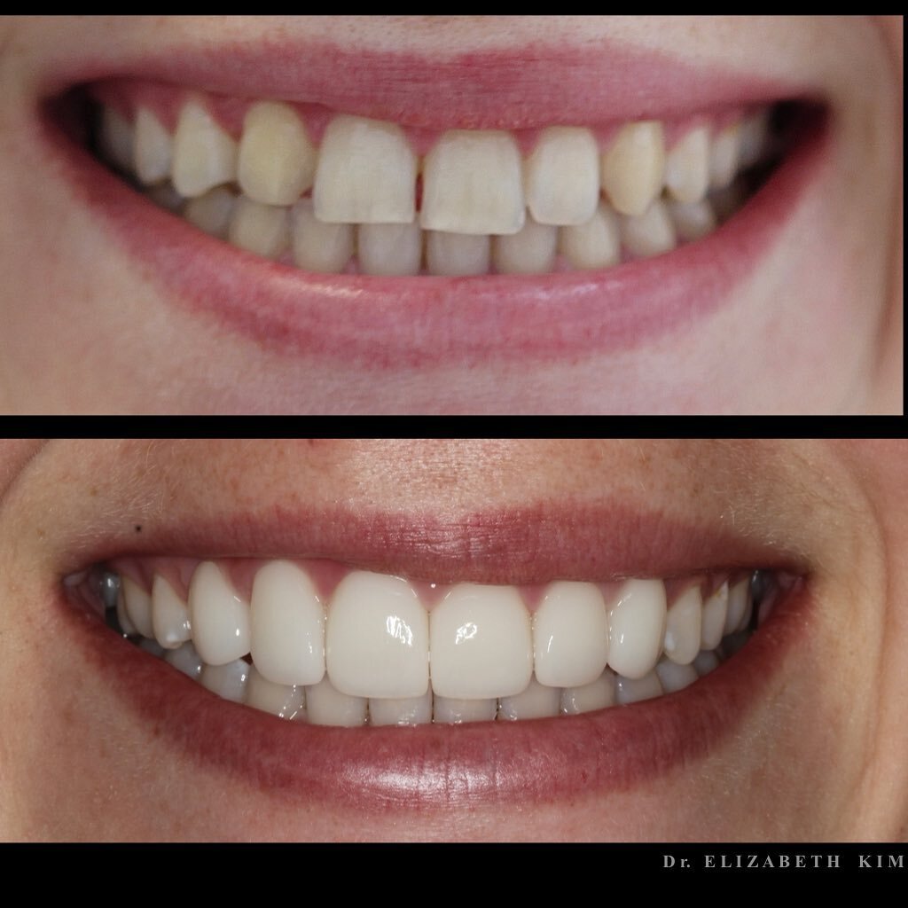 Restyling an asymmetrical and gappy smile due to a missing tooth with 6 porcelain veneers. Brightening the colour and changing the shapes to give the patient a gorgeous smile to match her personality! 
.
.
.
#porcelainveneers #smilemakeover #nzdentis