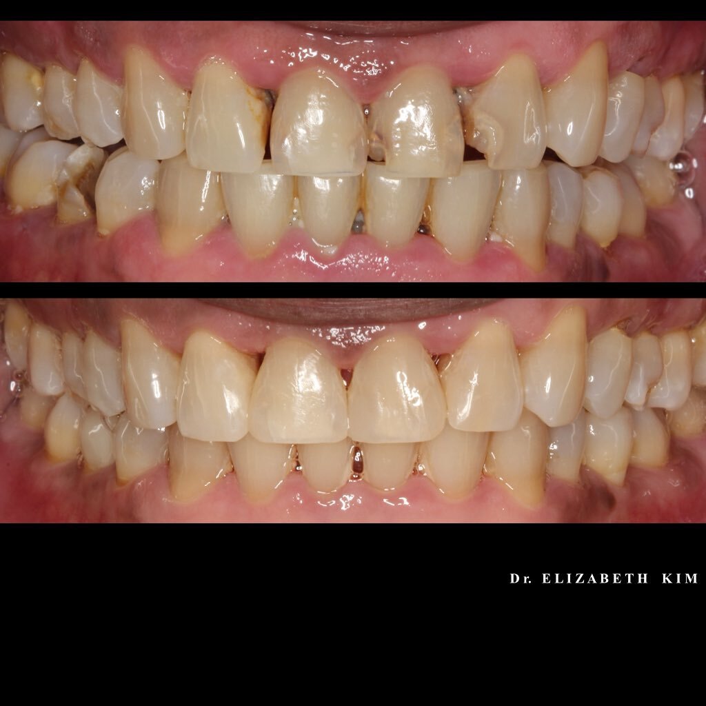 The importance of general dentistry - deep scaling and composite restorations makes a huge difference 😁 
.
.
.
.
#aucklanddnetist #cosmeticdentistry #scaling #composite #newzealand #smile #dentist #beforeandafter #cleanteeth