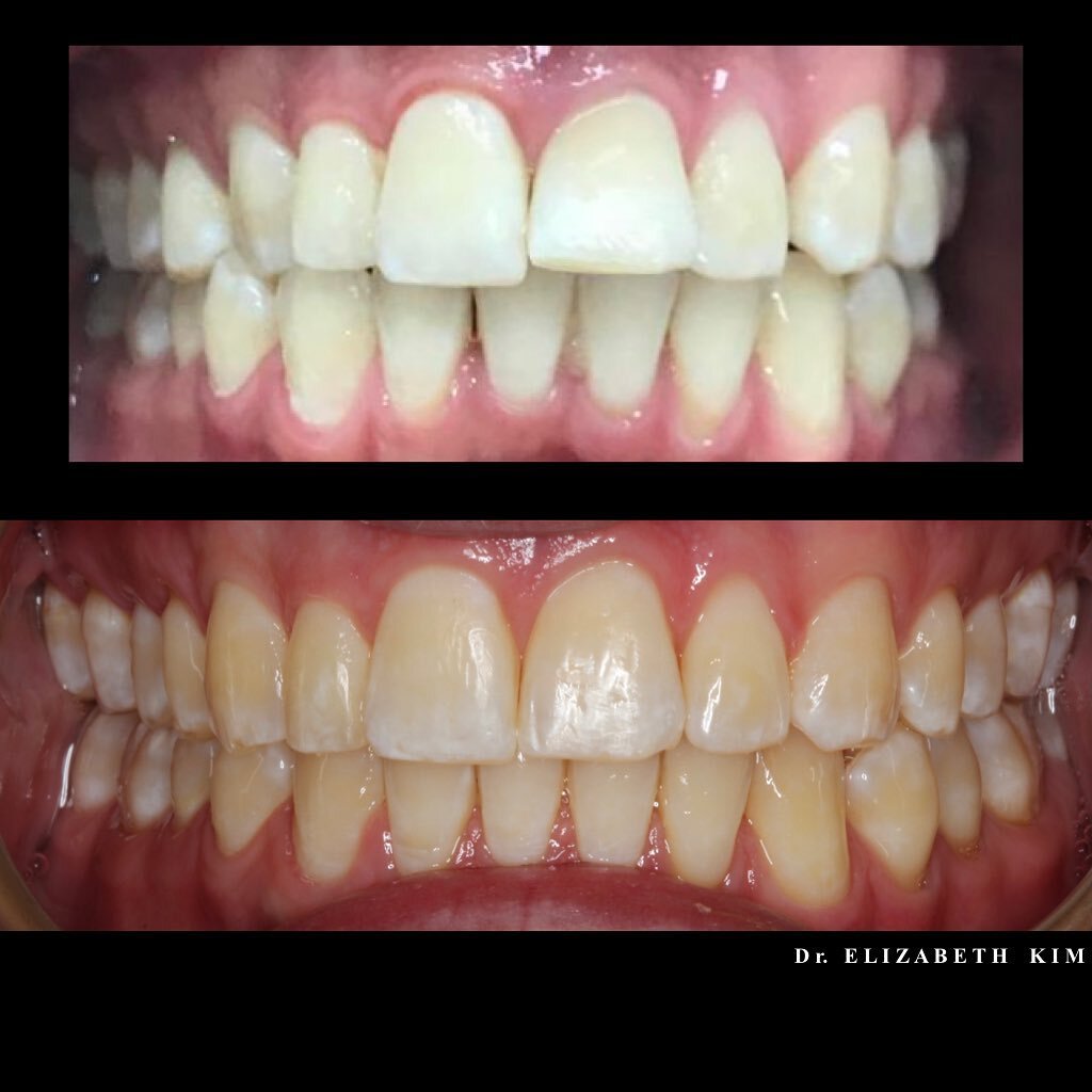The patient had braces when he was young and had a bonded retainer wire. However, the teeth relapsed, and especially unwinding of the wire caused the tooth to move unwanted direction. With  Invisalign, the patient got his smile back 😁
.
.
#invisalig