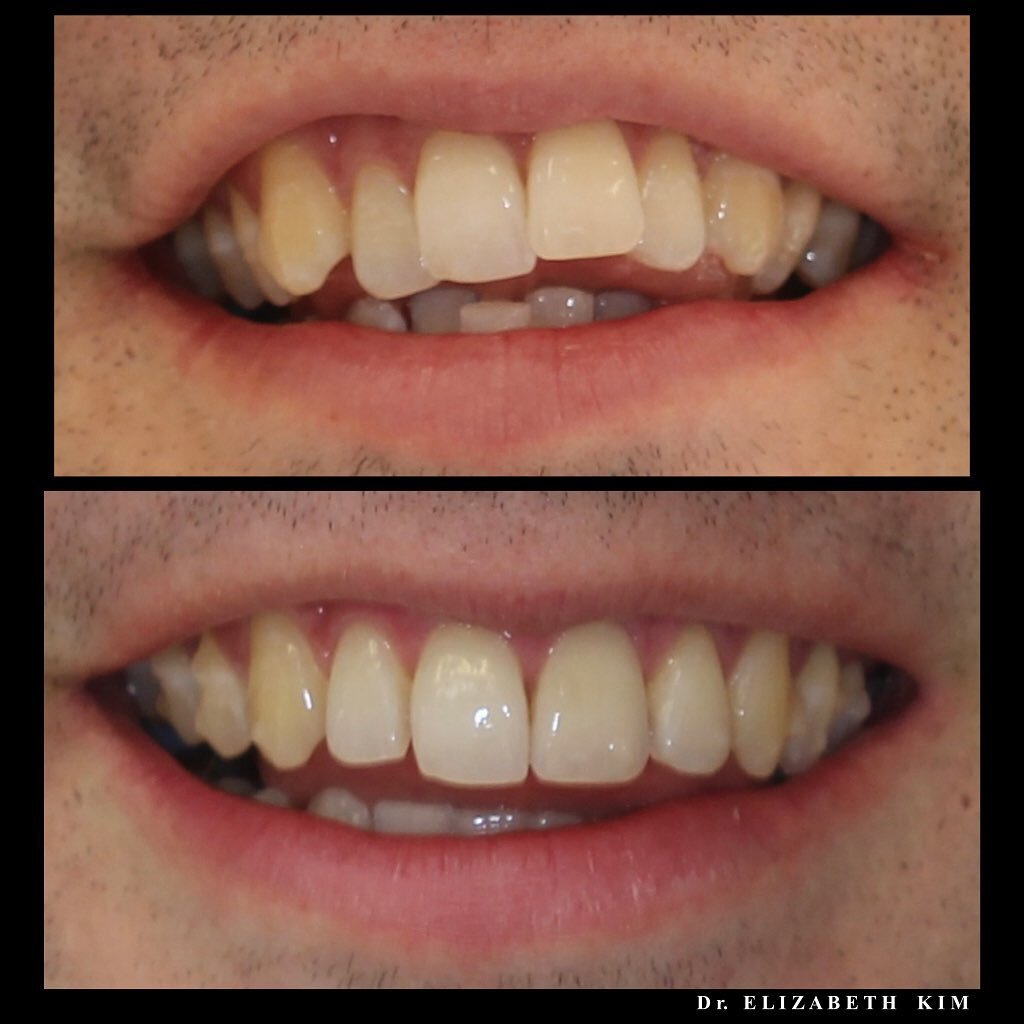The patient had a relapse from previous orthodontic treatment. There was a limit of how much we could move his teeth due to gum recession, but we have managed to bring back a great smile for him with Invisalign! 
.
.
.
.
#invisalign #invisalignsmile 