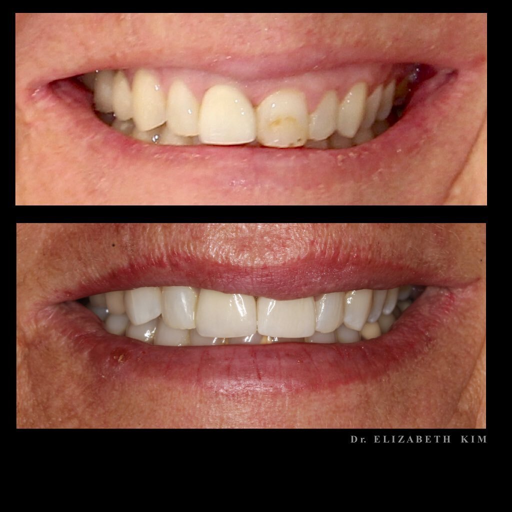 The patient had an old, chipped composite filling that was failing. We did a single veneer to match it to her implant-crown. 
.
.
.
#porcelainveneer #laminate #smiledesign #cosmeticdental #cosmeticdentistry #aucklanddentist #veneers #beforeandafter #