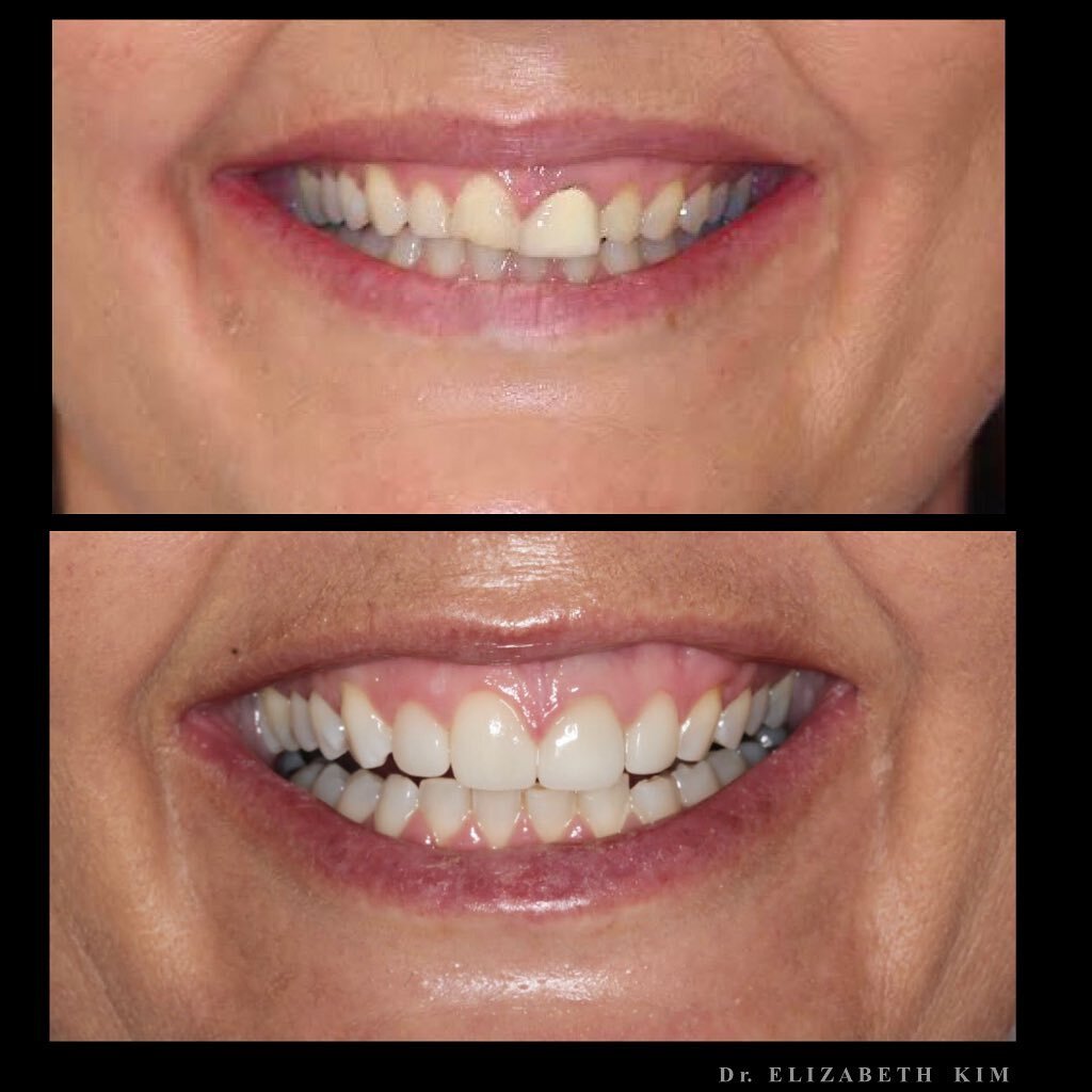 The patient had a crown placed after an accident that she did not like for years. The other teeth started to wear down, making her smile more uneven. We did a session of whitening and placed 3 porcelain veneers and a crown to transform her smile 😃 
