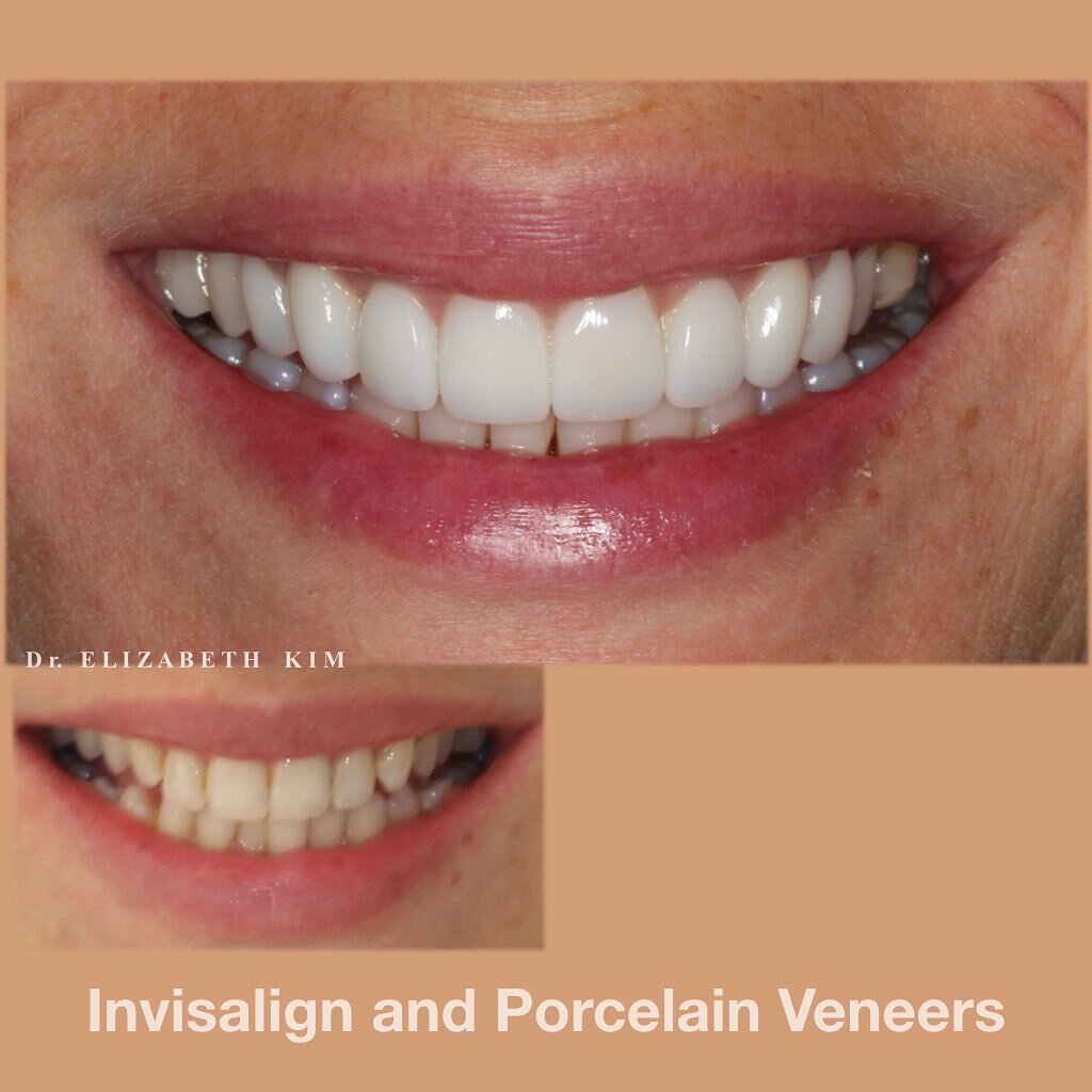 Our lovely patient has decided to completely transform her smile and boost her confidence as she was unhappy with the overall shape and colour of her smile. She opted for a combination of Invisalign, porcelain veneers and teeth whitening to help her 