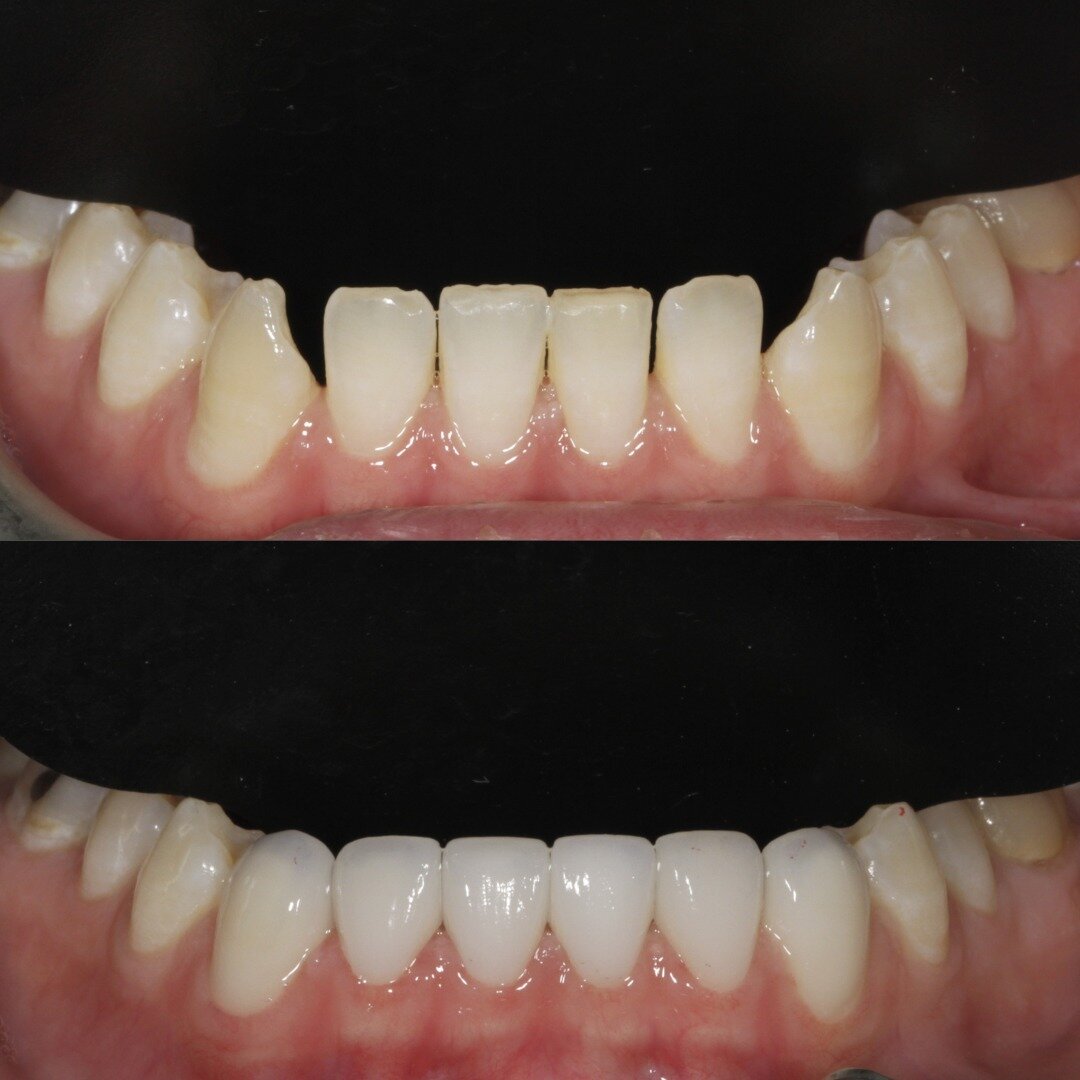🤔 Did you know you can get veneers for your lower teeth? 

If you show a lot of your bottom teeth when you smile and have always wanted a perfect smile, or if your lower teeth are discoloured or worn down, then veneers can be your ultimate solution!
