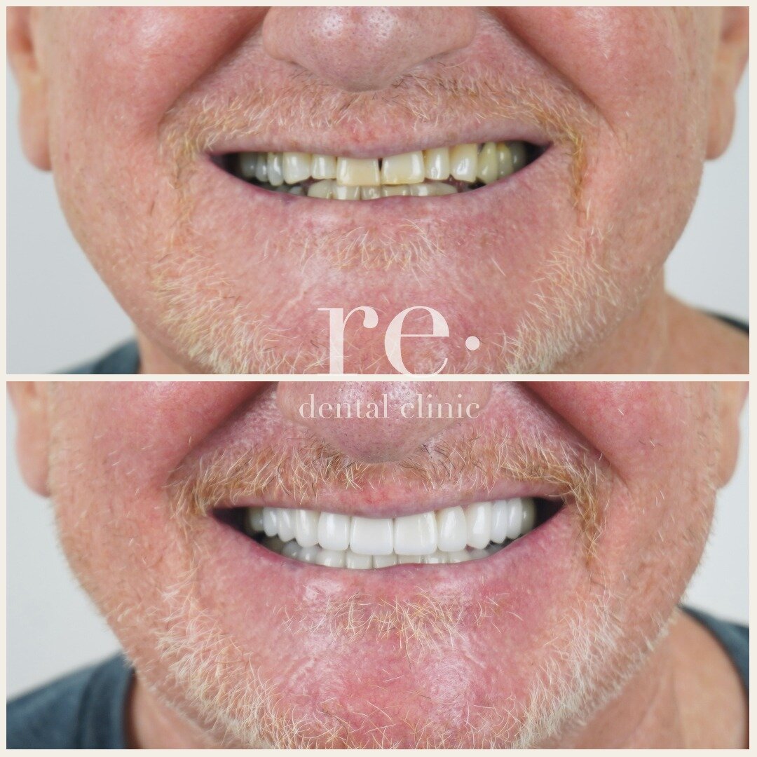 &quot;I like my white teeth!&quot; 
Every journey starts with a simple desire. For some, it's as modest as 'I just want a nice smile.' Here's a glimpse into a smile re&middot;juvenation journey with 20 porcelain veneers, breathing new life into an ag