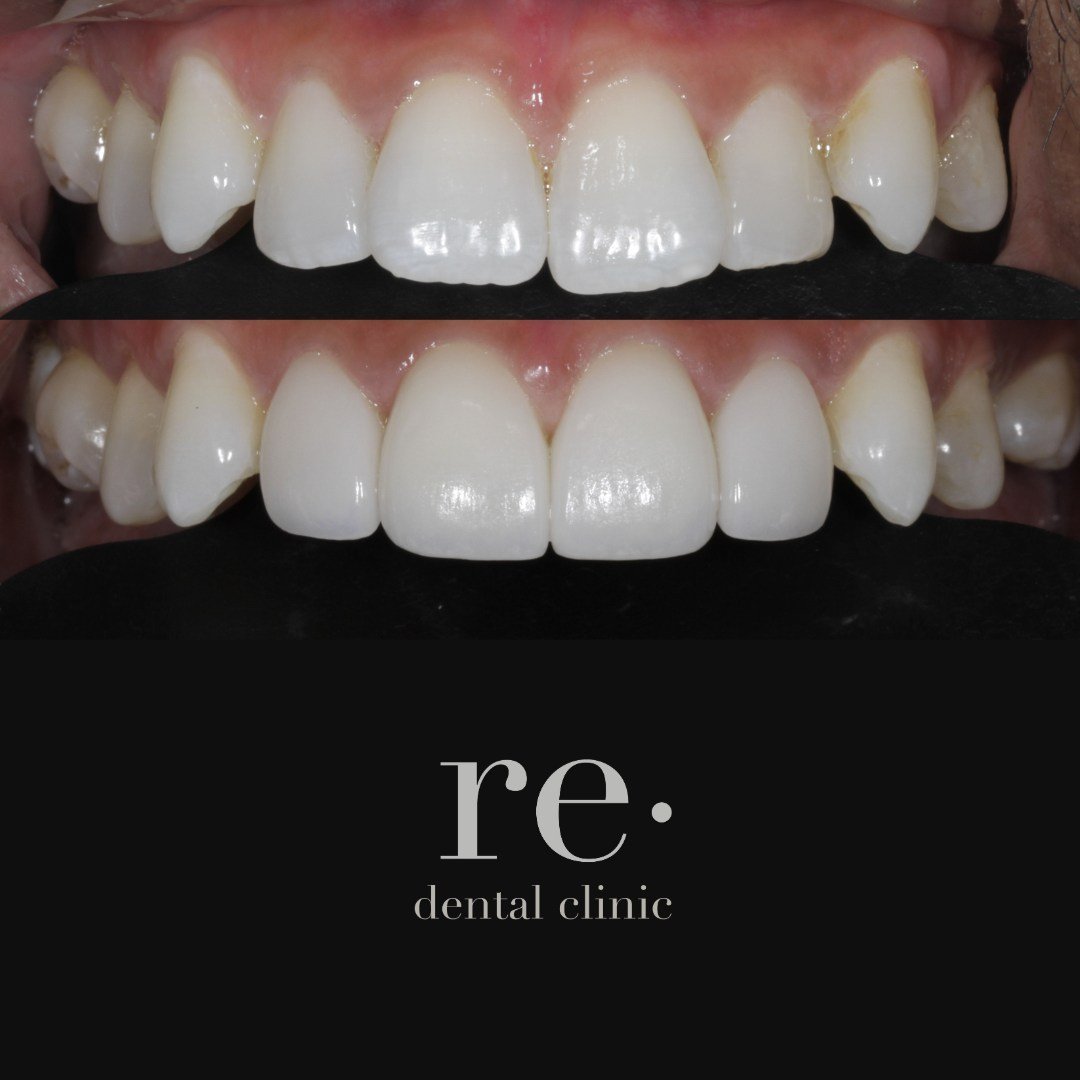 We are here to help you achieve a smile that is uniquely yours. 

Our recent patient came in wanting to enhance their smile with a subtle refinement without altering its natural essence. By delicately balancing and harmonizing their front teeth, we c