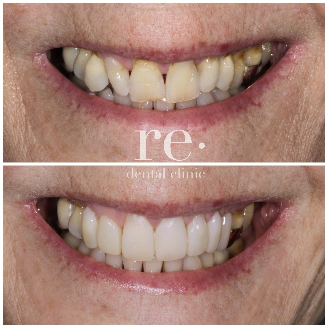 Ready for a Smile Makeover? 🌟

Feeling self-conscious about your smile? Imagine looking in the mirror and seeing a perfect, dazzling smile every day! 

Our Composite Veneers are here to make that a reality &ndash; affordable and effective.

Join cou