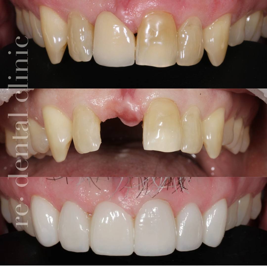 Did you know combining a porcelain bridge with porcelain veneers can offer an exceptional alternative for missing teeth? This dynamic duo not only fills gaps but also enhances the overall aesthetics of your smile, giving you a fuller, more radiant lo