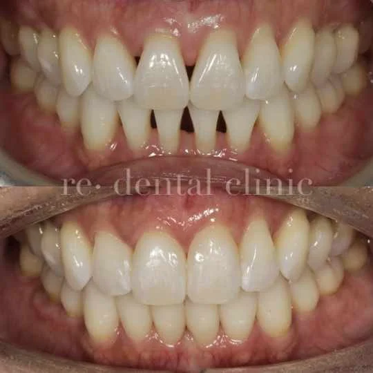 Black Triangles Re Dental Clinic