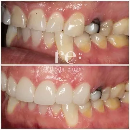 Enamel erosion due to wear and tear and an acidic diet can cause enamel thinning, which is more transparent and prone to damage. Porcelain veneers are used to restore what has been lost and protect teeth from further damage