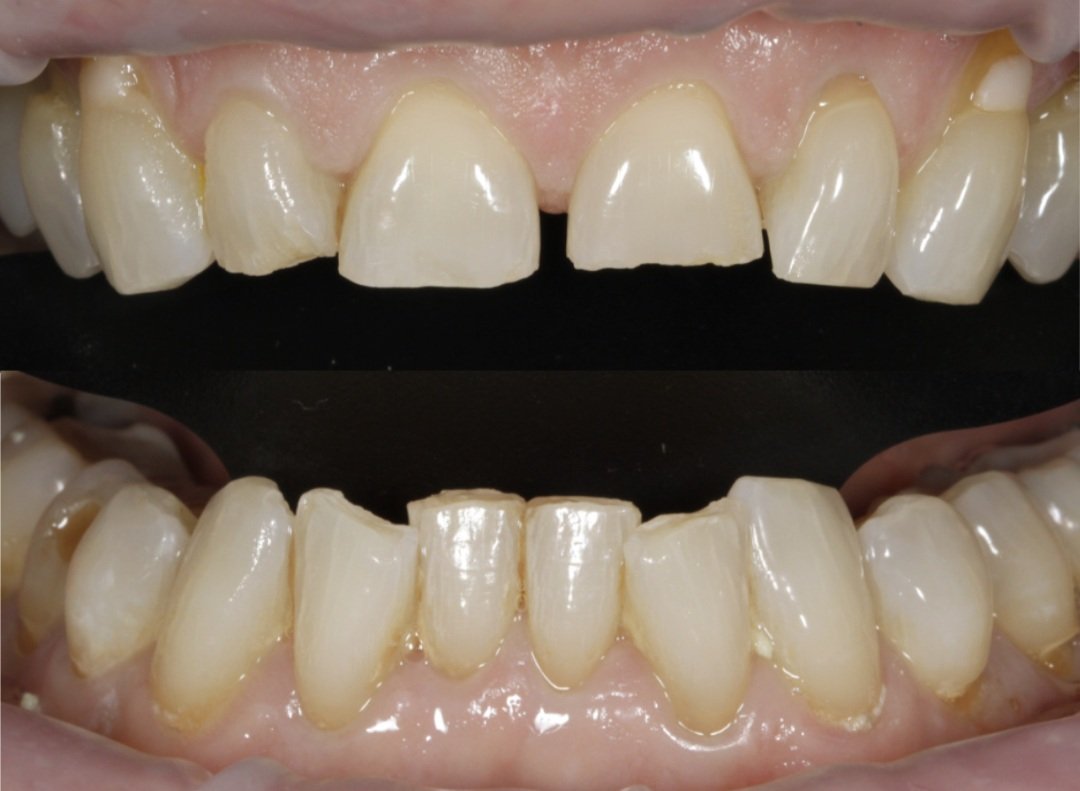 Ageing Teeth: Signs and Symptoms You Shouldn't Ignore | Re- Dental Clinic