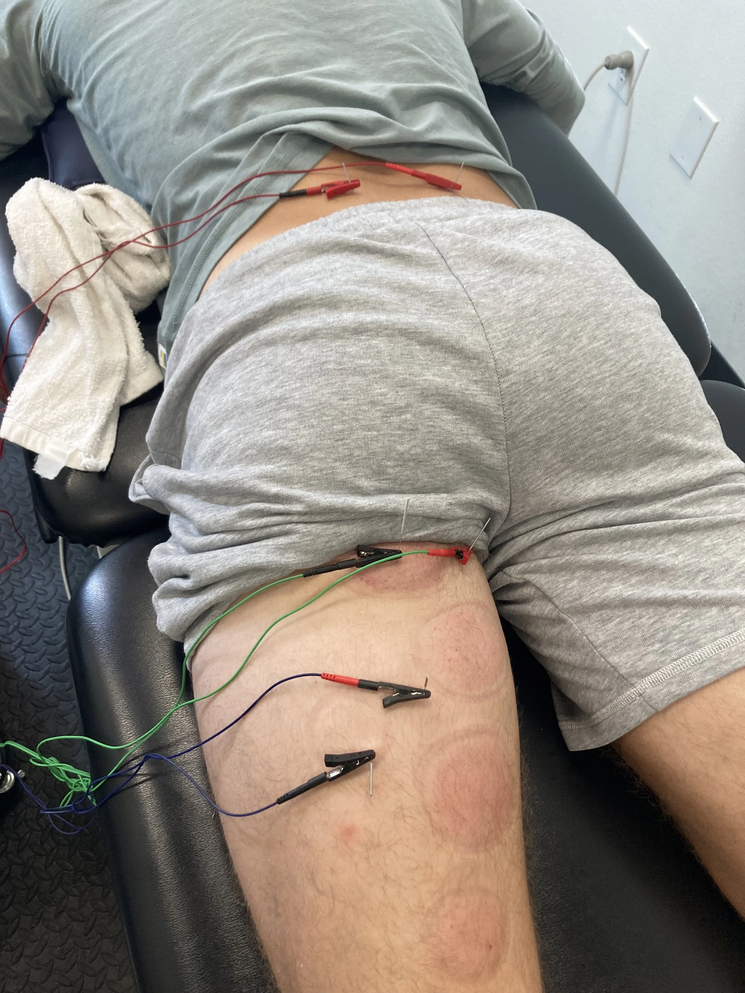 What is Dry Needling?  