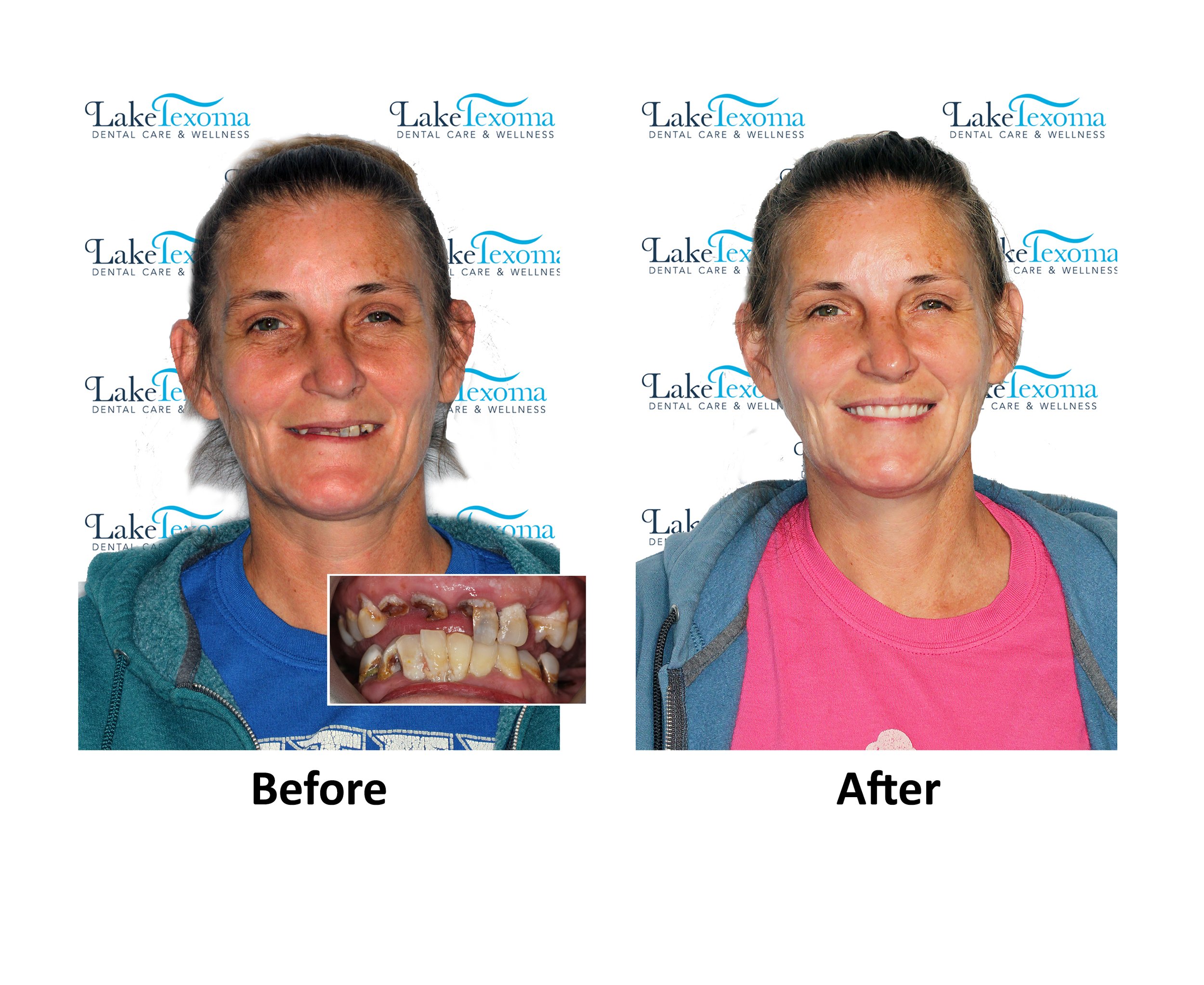 C Booth - Dentures - Before After.jpg