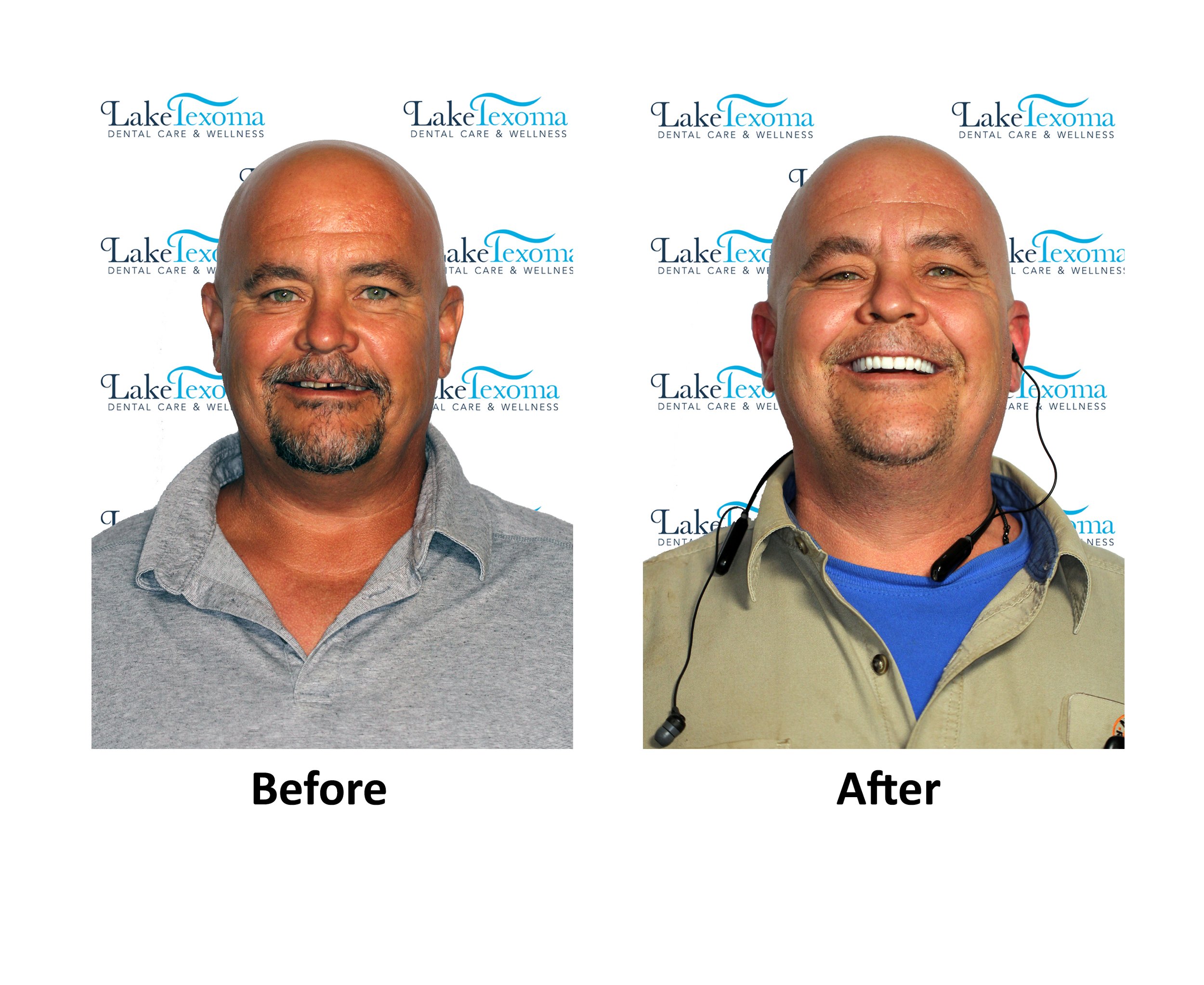 Danny K - Implant Dentures - Before After .jpg