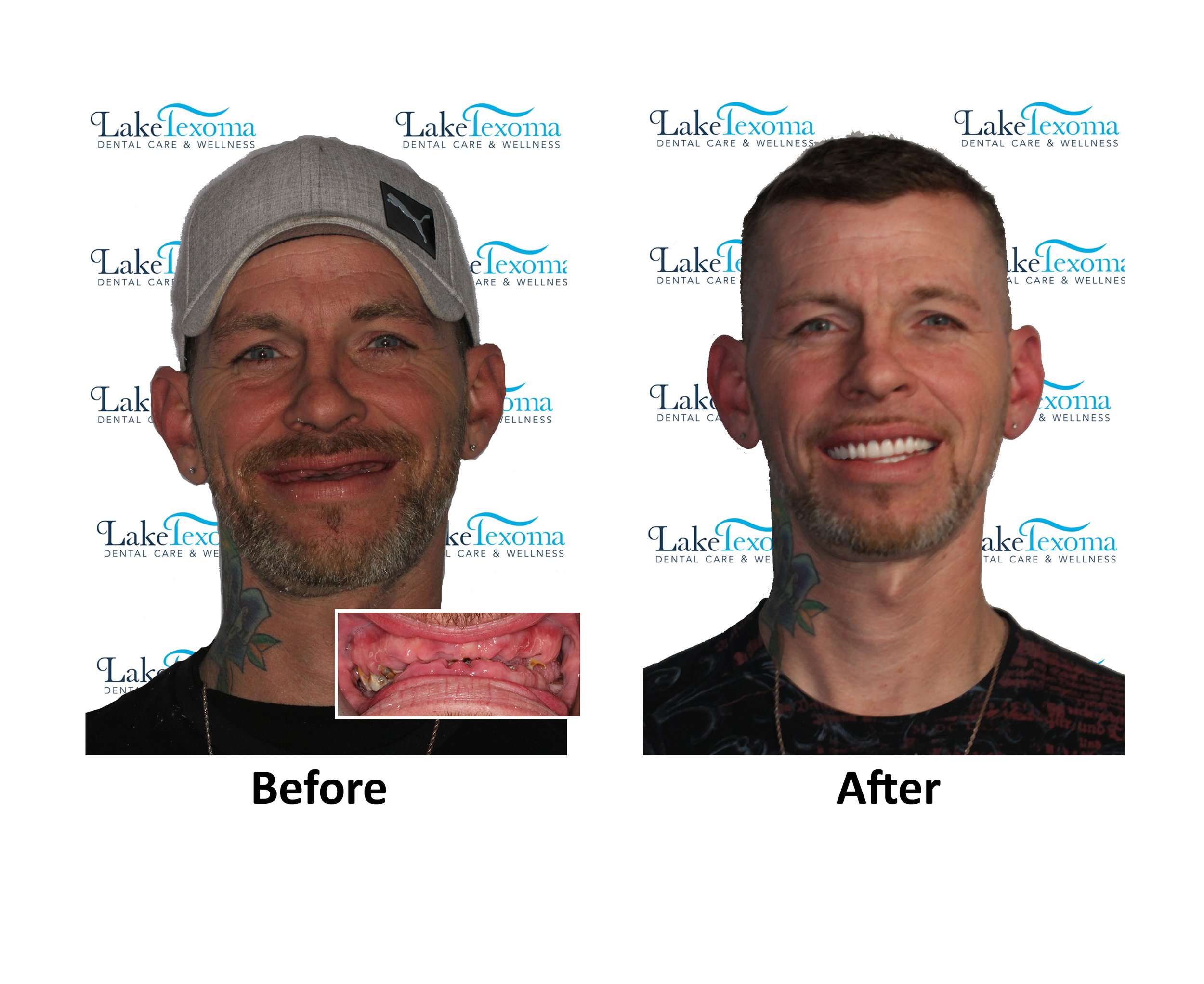 C Jenkins - Dentures - Before After.jpg
