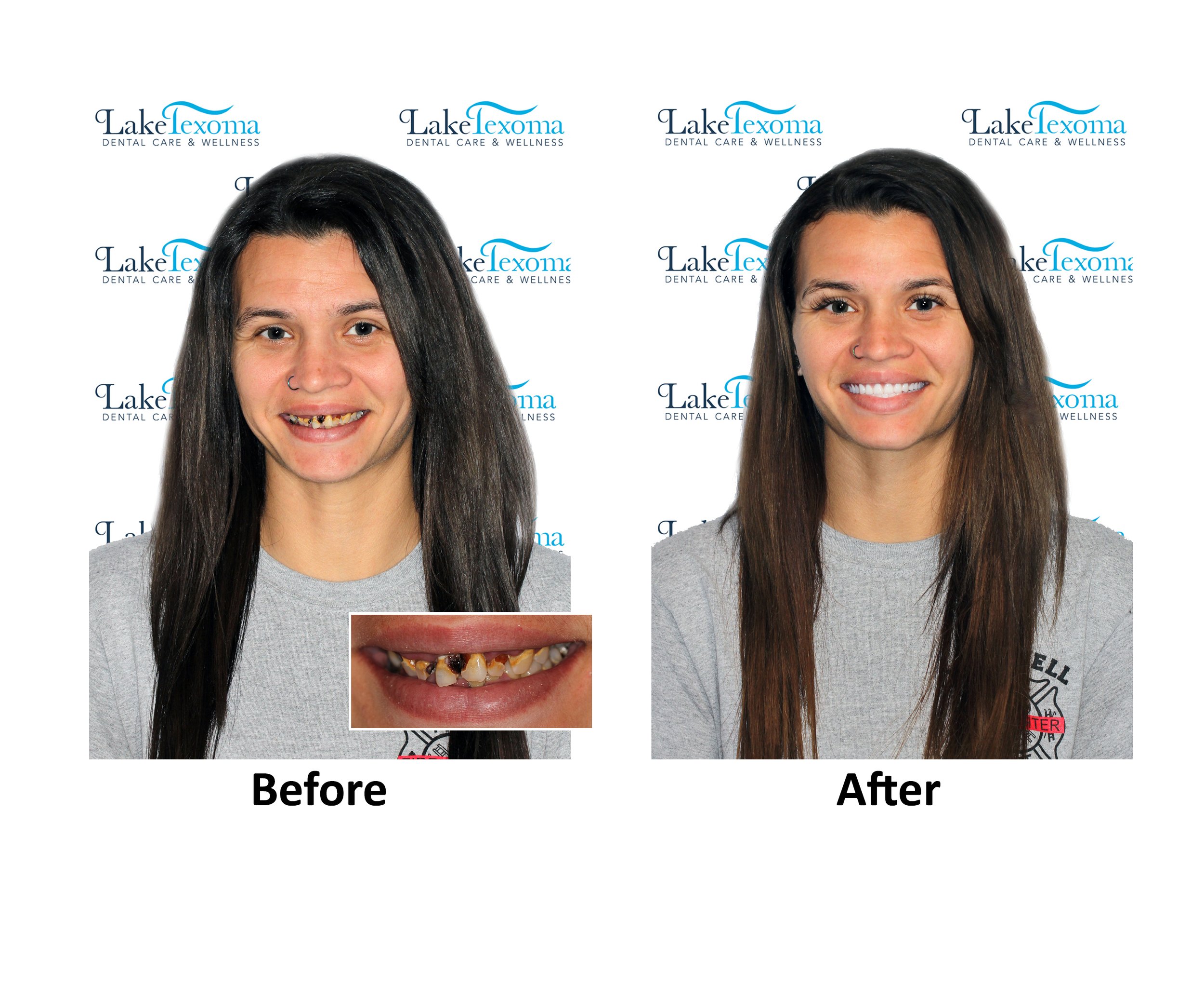 N Nelson - Dentures - Before After.jpg